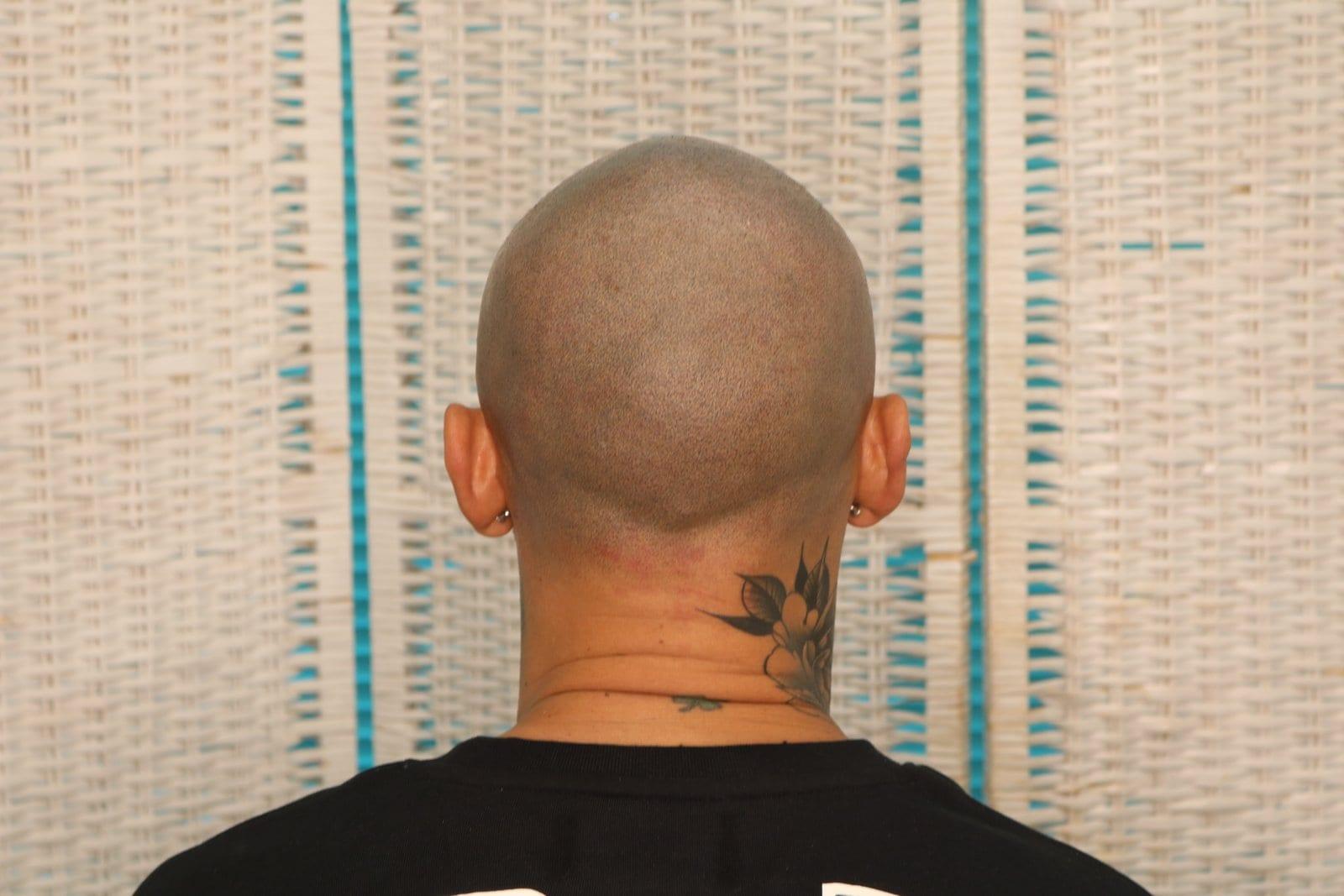 Dopo: tricopigmentazione alopecia universale a Firenze — Caso Prima / Dopo #40 (foto 1)
