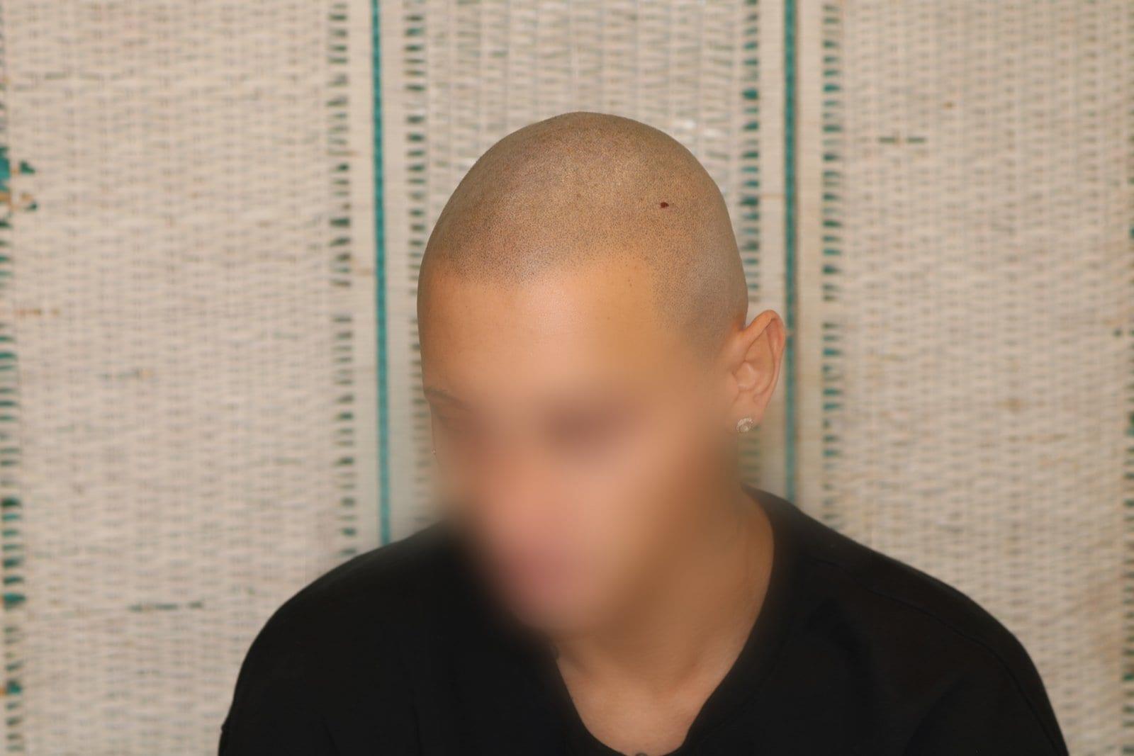 Dopo: tricopigmentazione alopecia universale a Firenze — Caso Prima / Dopo #40 (foto 2)