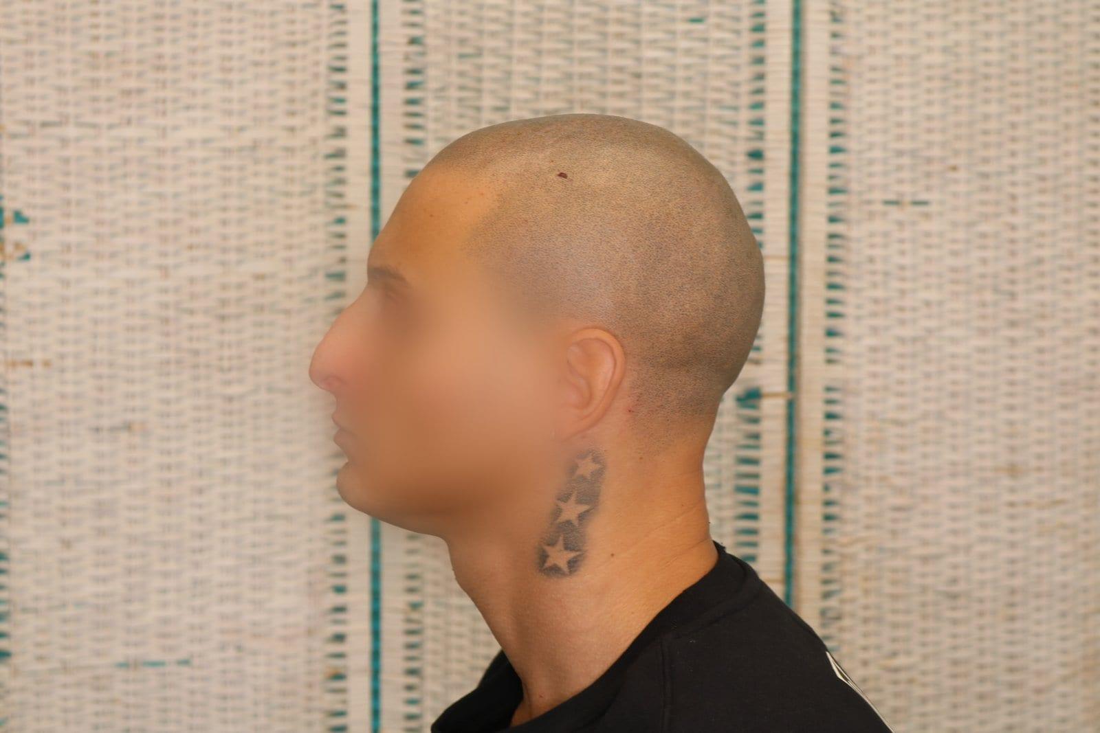 Dopo: tricopigmentazione alopecia universale a Firenze — Caso Prima / Dopo #40 (foto 3)