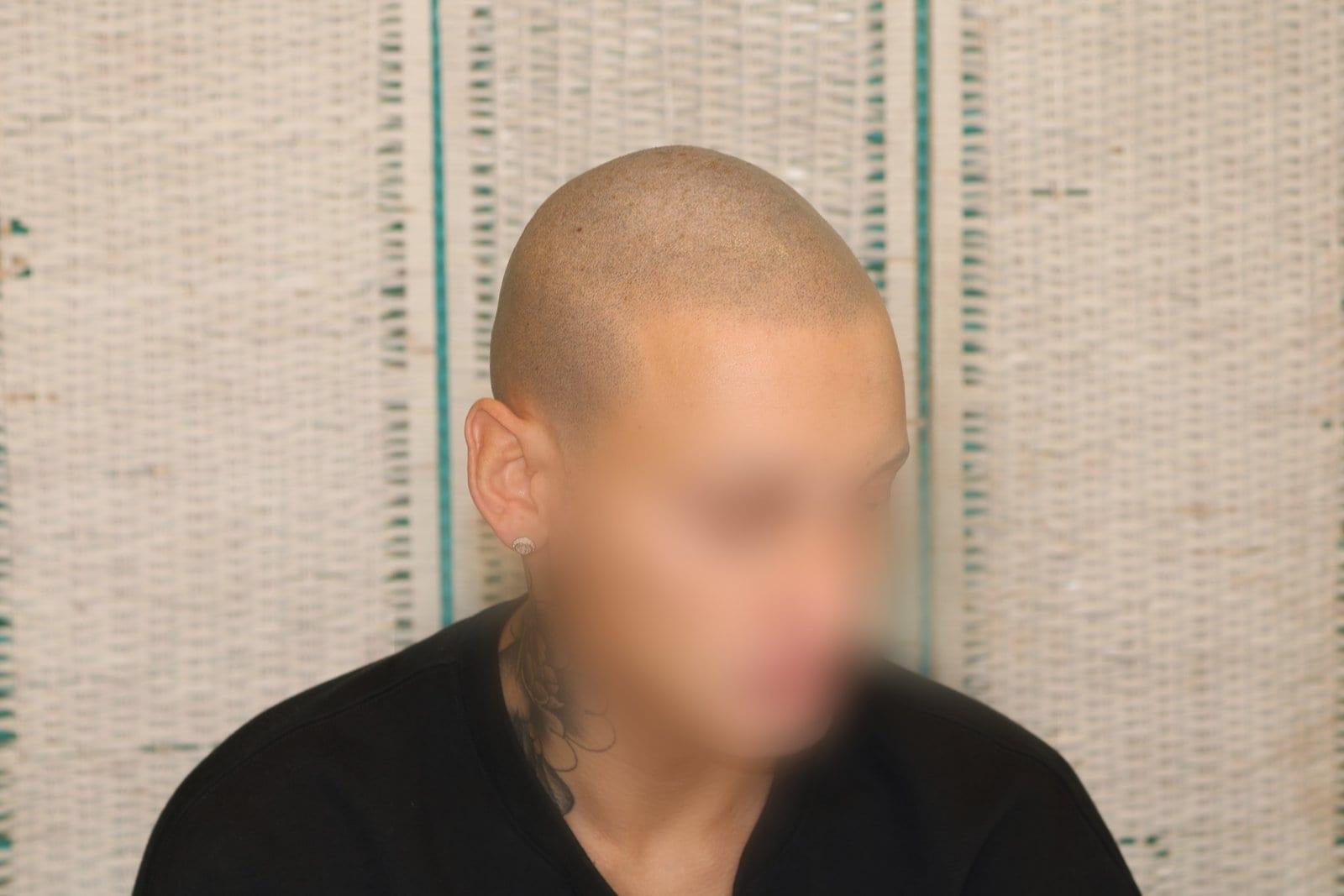 Dopo: tricopigmentazione alopecia universale a Firenze — Caso Prima / Dopo #40 (foto 4)