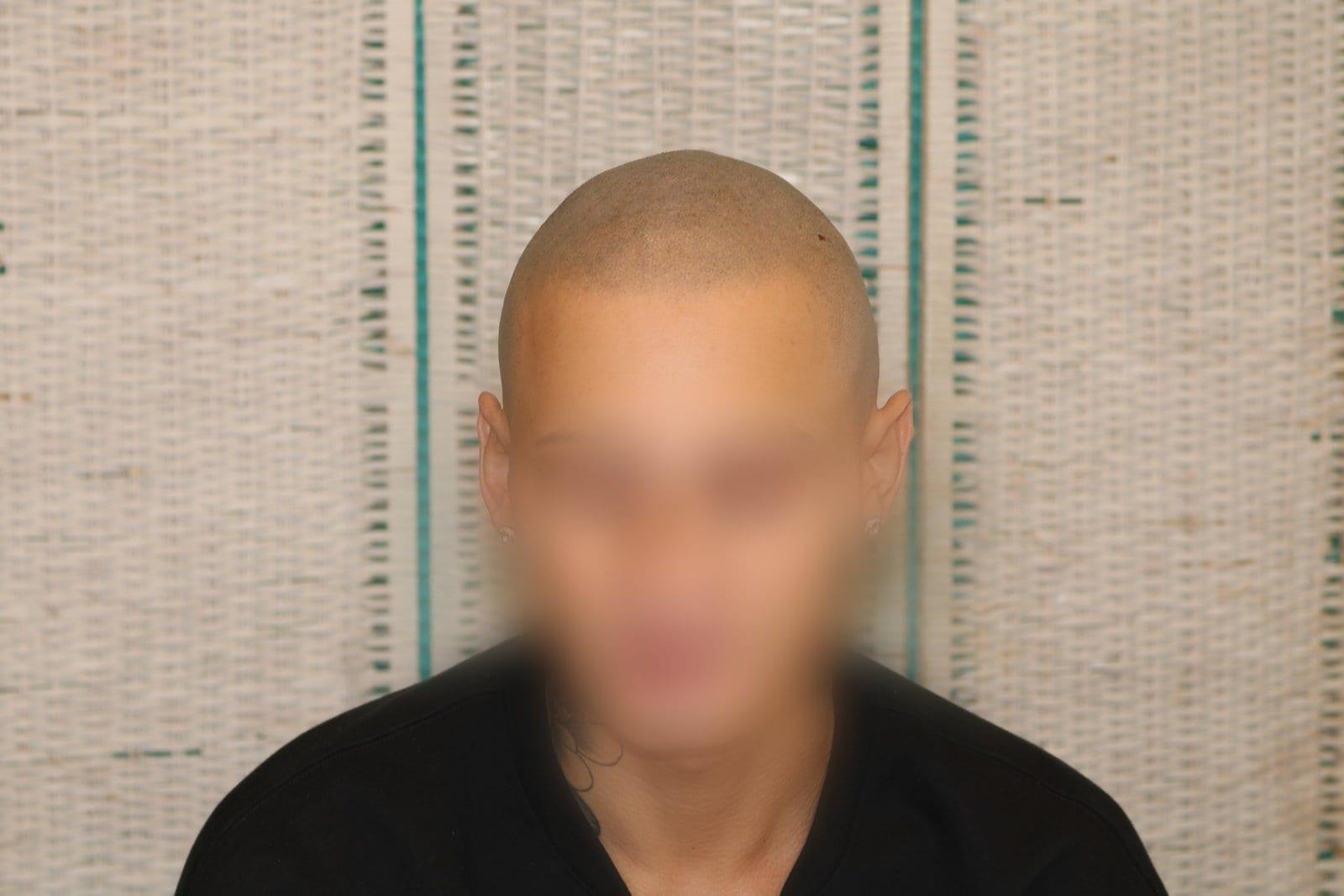 Dopo: tricopigmentazione alopecia universale a Firenze — Caso Prima / Dopo #40 (foto 5)