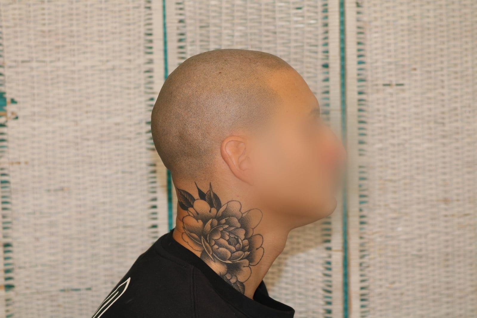 Dopo: tricopigmentazione alopecia universale a Firenze — Caso Prima / Dopo #40 (foto 6)