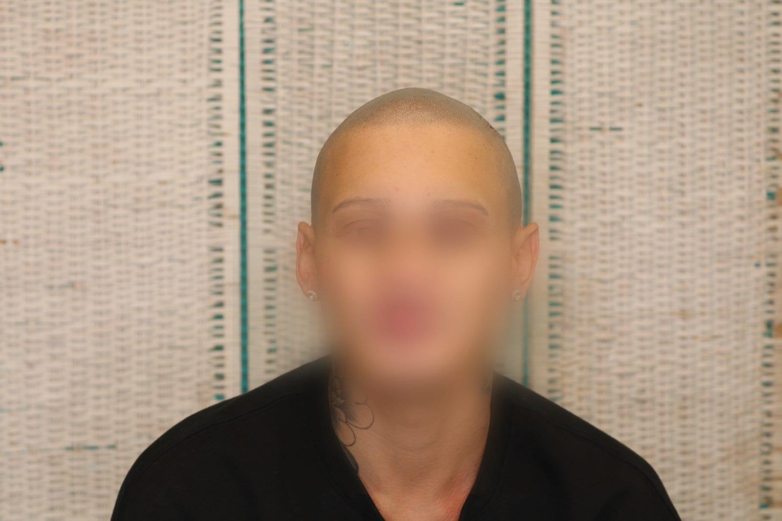 Dopo: tricopigmentazione alopecia universale a Firenze — Caso Prima / Dopo #40 (foto 7)