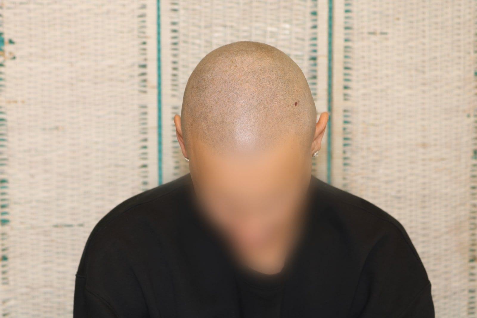 Dopo: tricopigmentazione alopecia universale a Firenze — Caso Prima / Dopo #40 (foto 8)