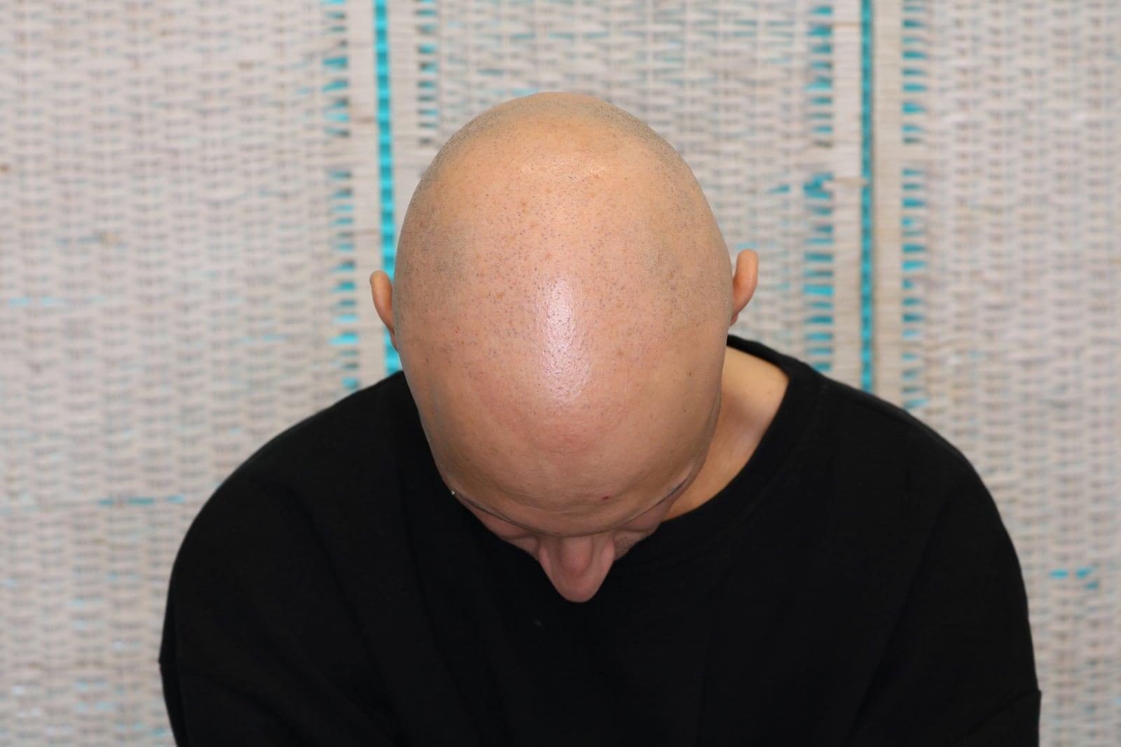 Prima: tricopigmentazione alopecia universale a Firenze — Caso Prima / Dopo #40 (foto 1)