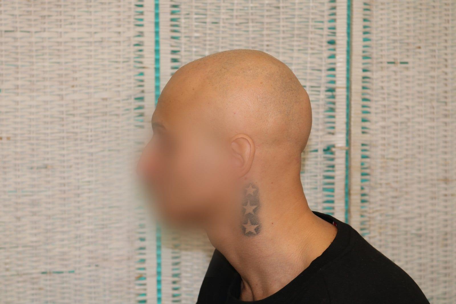 Prima: tricopigmentazione alopecia universale a Firenze — Caso Prima / Dopo #40 (foto 2)