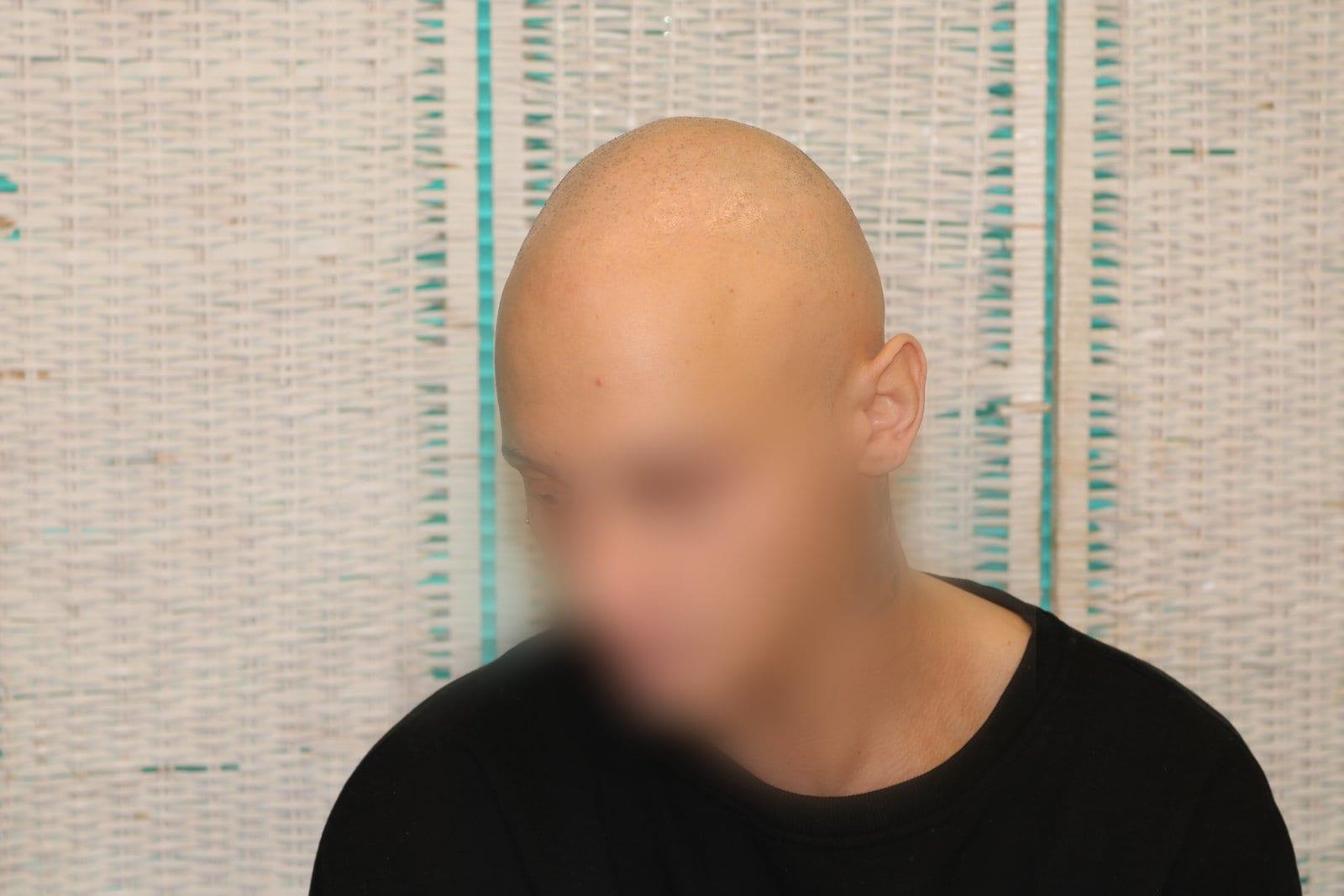 Prima: tricopigmentazione alopecia universale a Firenze — Caso Prima / Dopo #40 (foto 3)