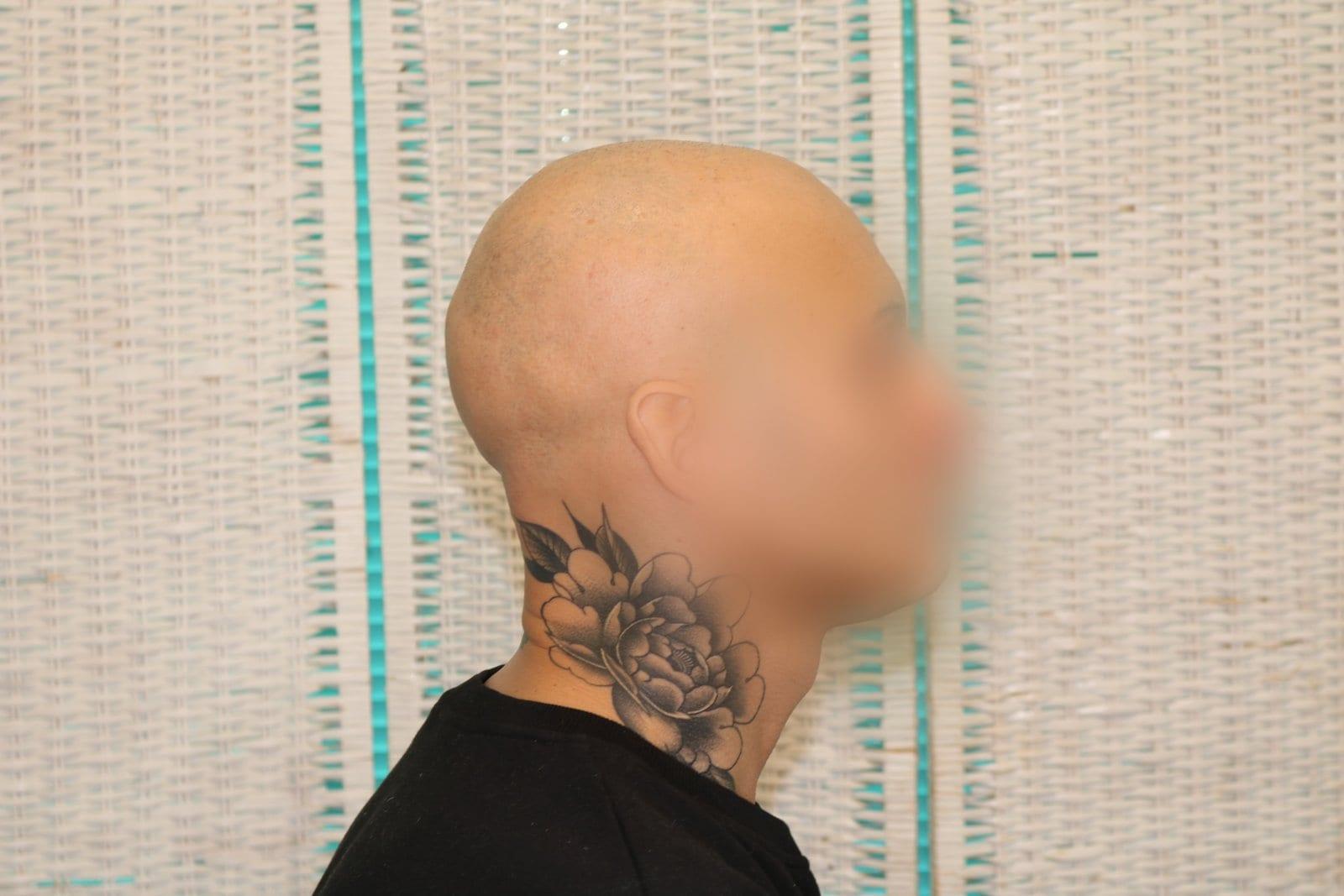 Prima: tricopigmentazione alopecia universale a Firenze — Caso Prima / Dopo #40 (foto 4)