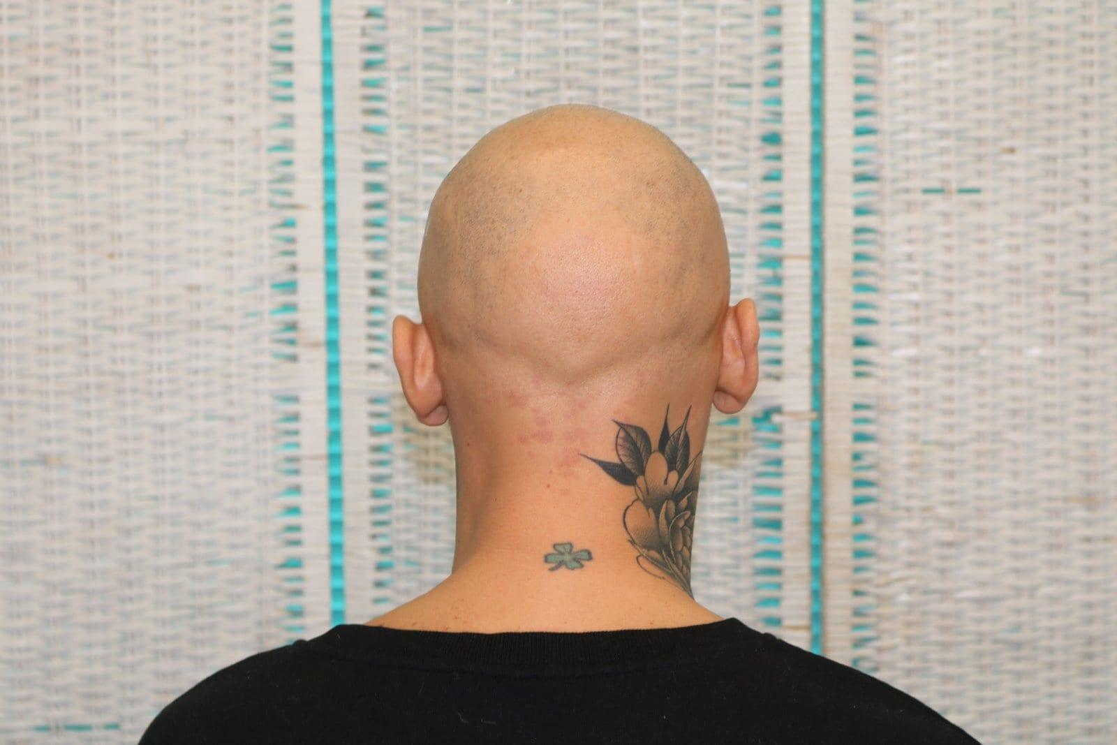 Prima: tricopigmentazione alopecia universale a Firenze — Caso Prima / Dopo #40 (foto 5)