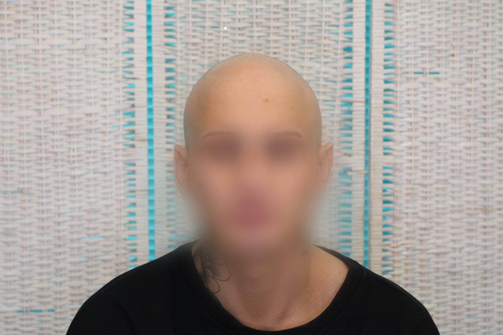 Prima: tricopigmentazione alopecia universale a Firenze — Caso Prima / Dopo #40 (foto 6)