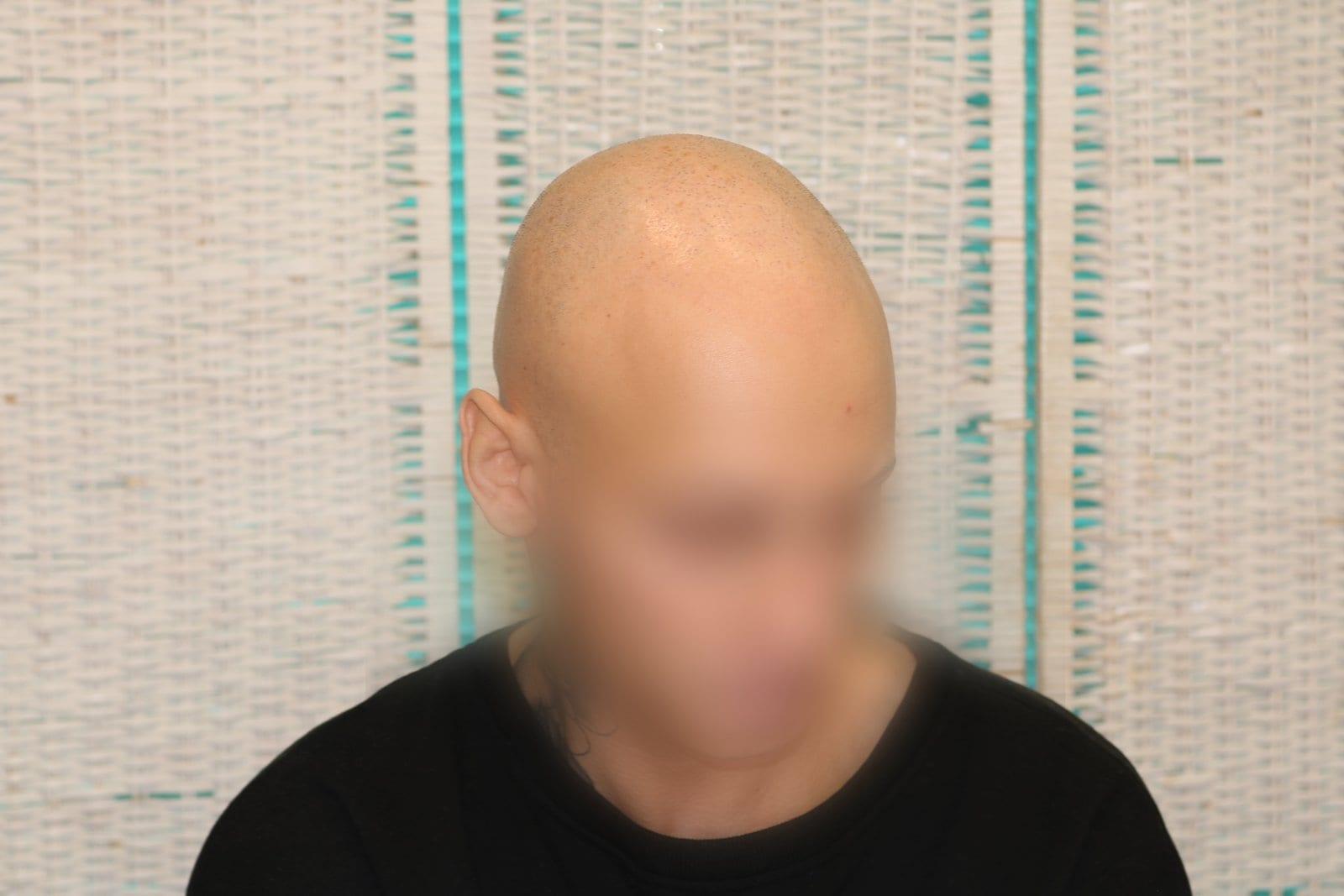 Prima: tricopigmentazione alopecia universale a Firenze — Caso Prima / Dopo #40 (foto 7)