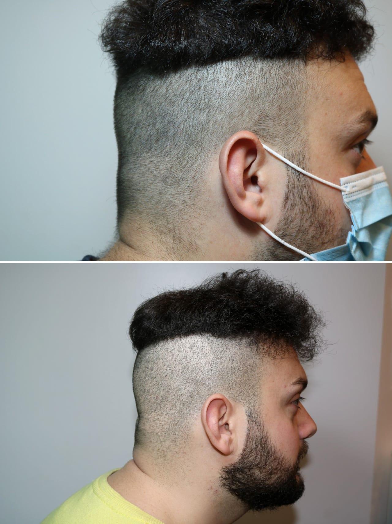 Tricopigmentazione, prima e dopo, caso #68, Firenze