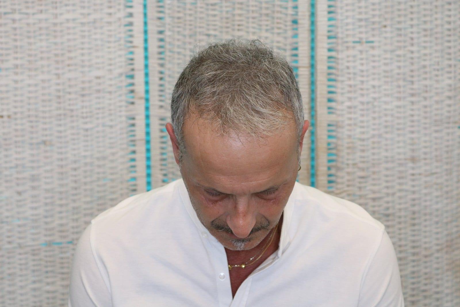 Dopo: tricopigmentazione effetto infoltimento a Firenze — Caso Prima / Dopo #21 (foto 2)