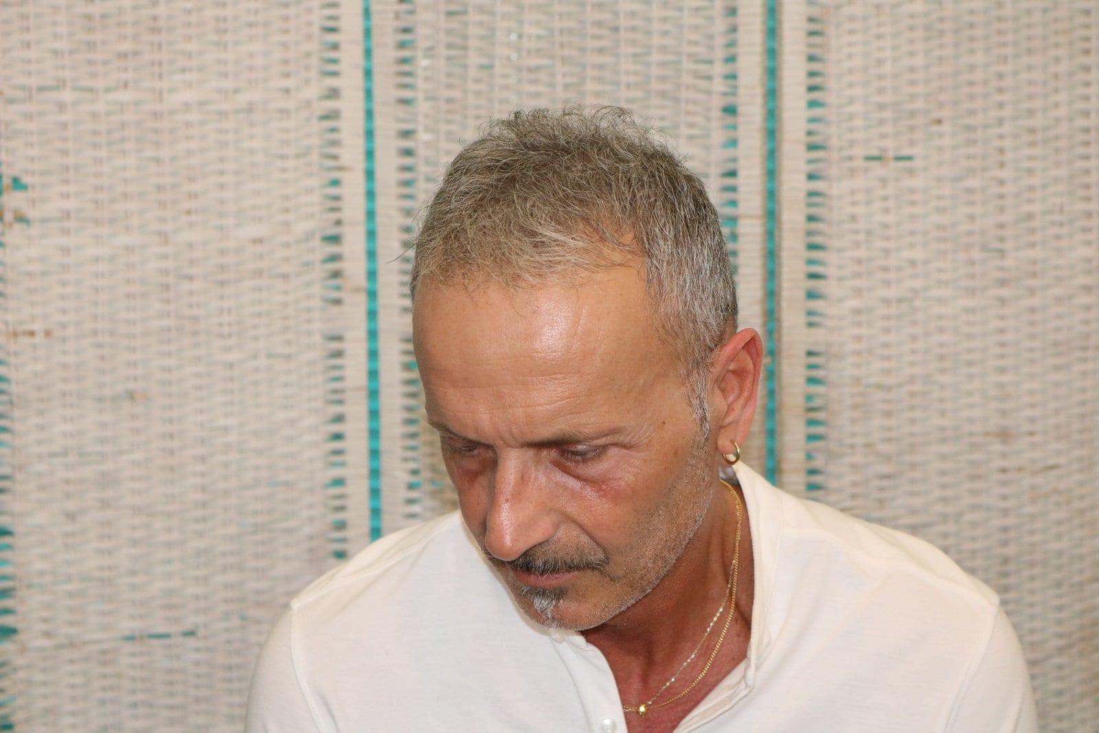 Dopo: tricopigmentazione effetto infoltimento a Firenze — Caso Prima / Dopo #21 (foto 3)