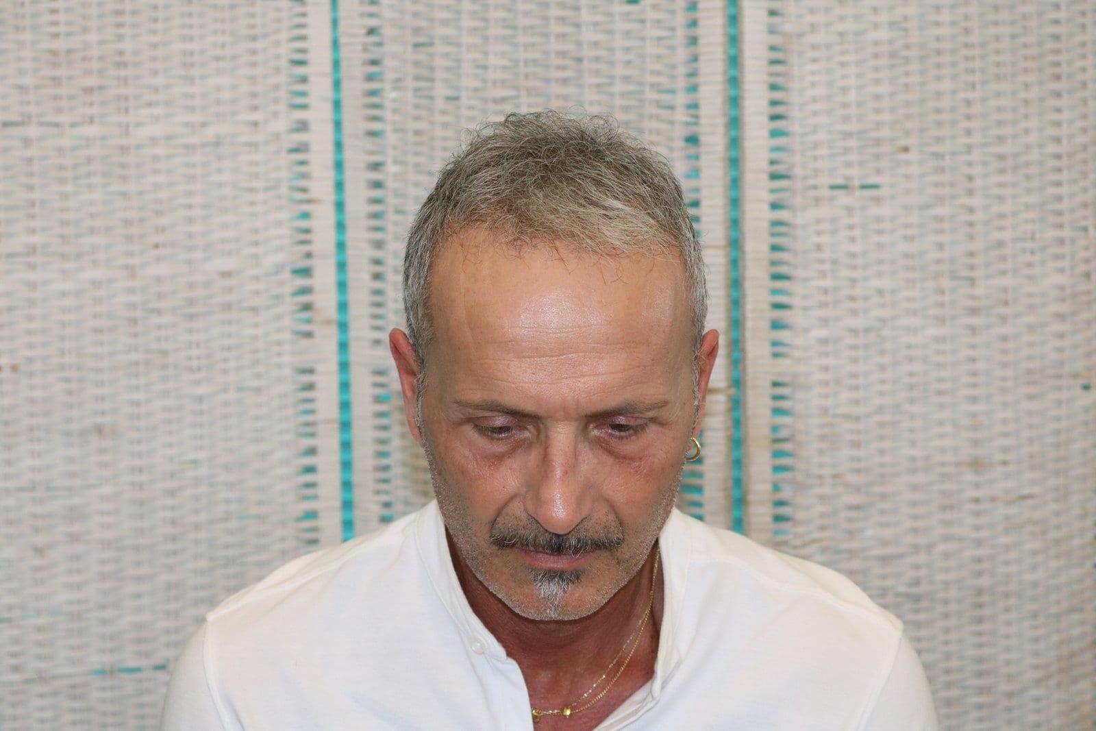 Dopo: tricopigmentazione effetto infoltimento a Firenze — Caso Prima / Dopo #21 (foto 5)