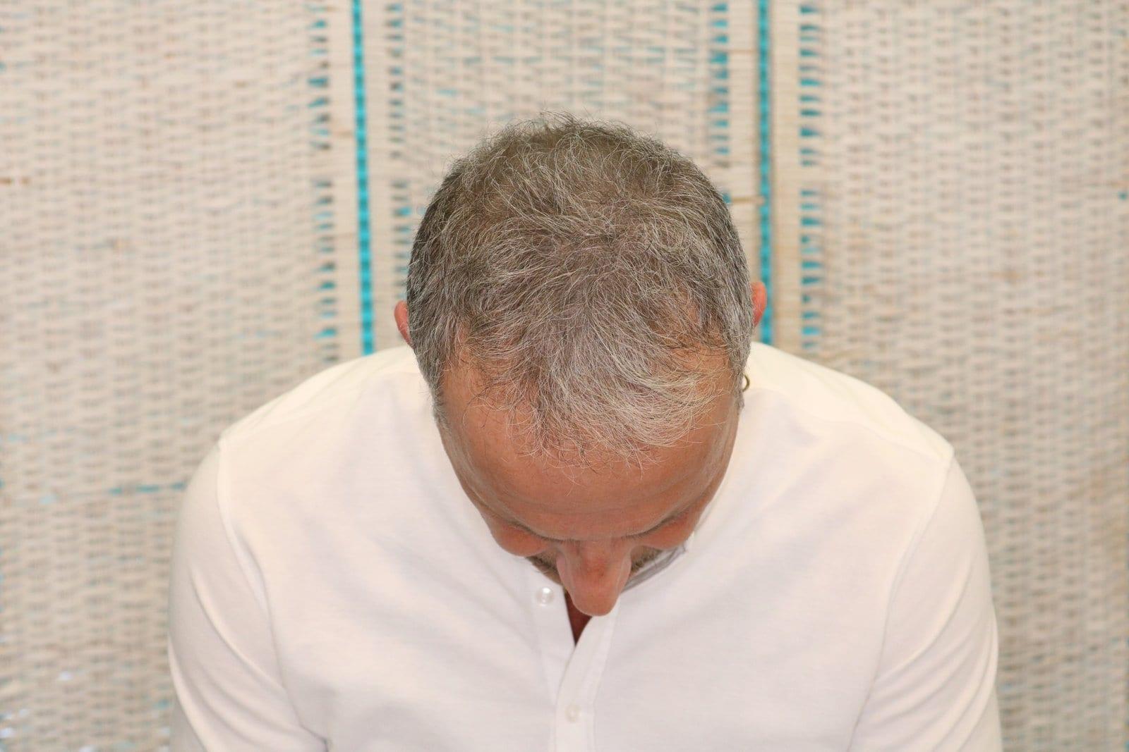 Dopo: tricopigmentazione effetto infoltimento a Firenze — Caso Prima / Dopo #21 (foto 7)