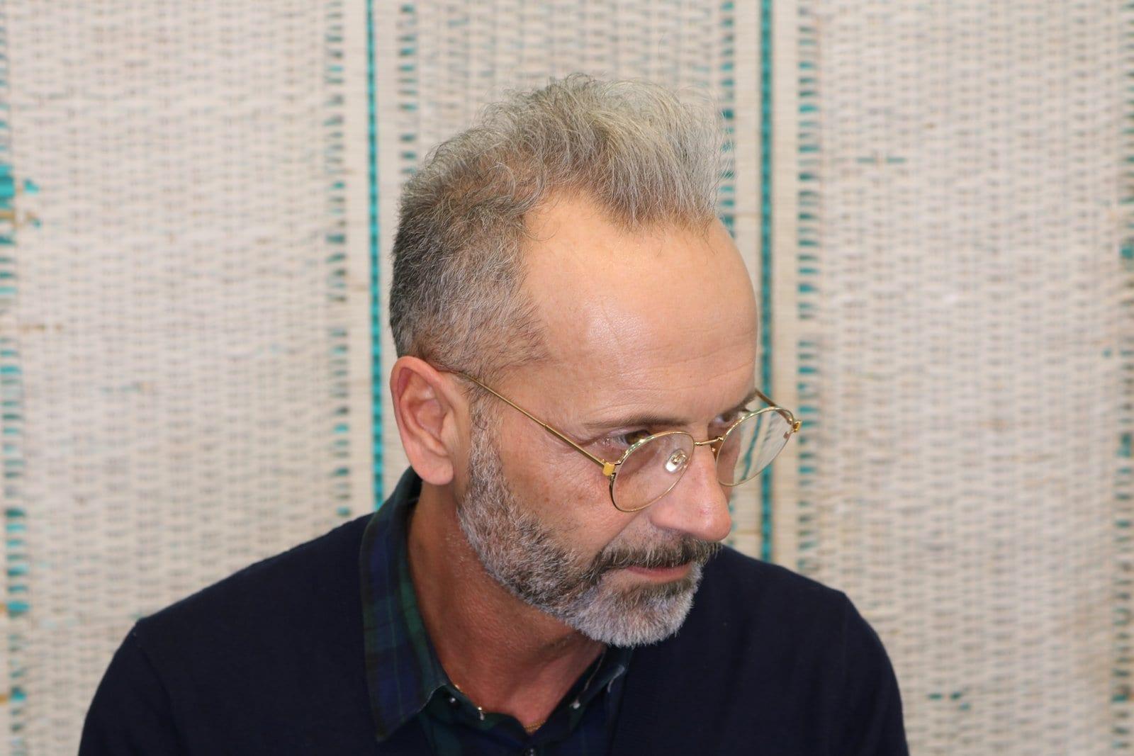 Prima: tricopigmentazione effetto infoltimento a Firenze — Caso Prima / Dopo #21 (foto 1)