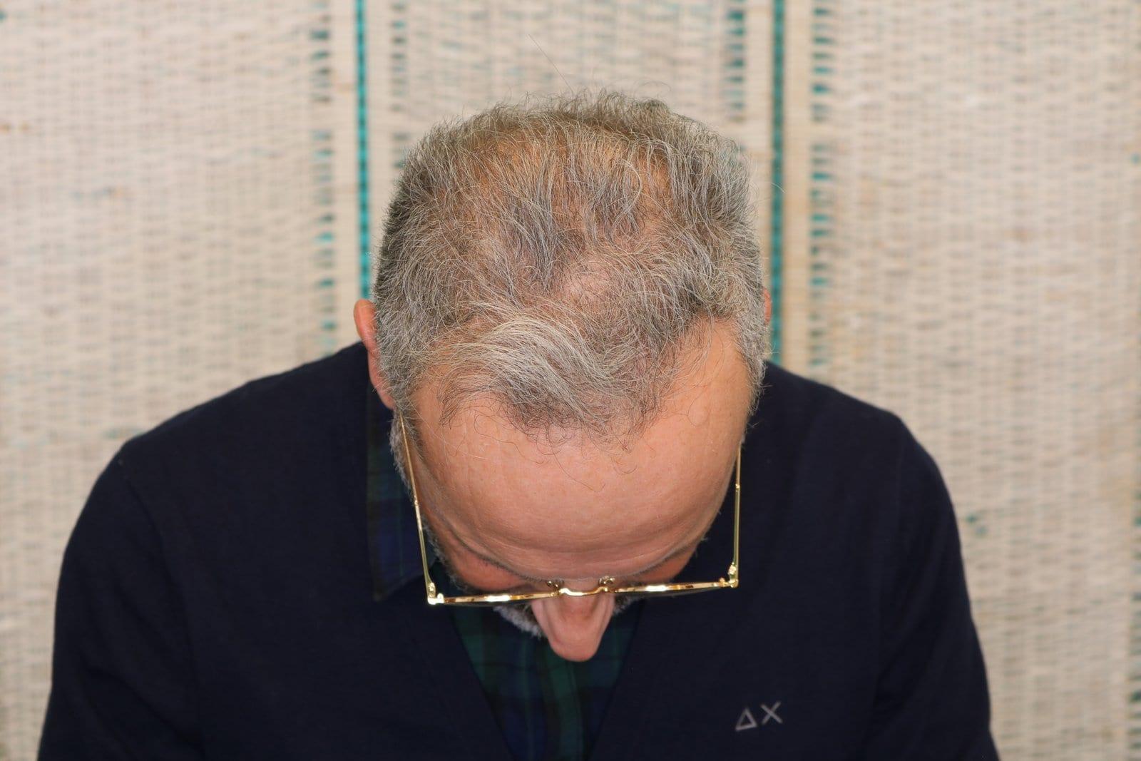 Prima: tricopigmentazione effetto infoltimento a Firenze — Caso Prima / Dopo #21 (foto 2)