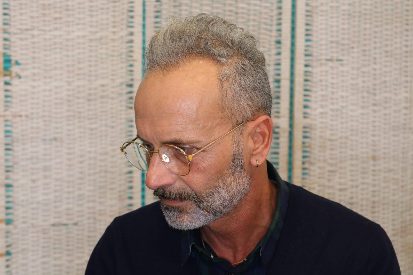 Prima: tricopigmentazione effetto infoltimento a Firenze — Caso Prima / Dopo #21 (foto 4)