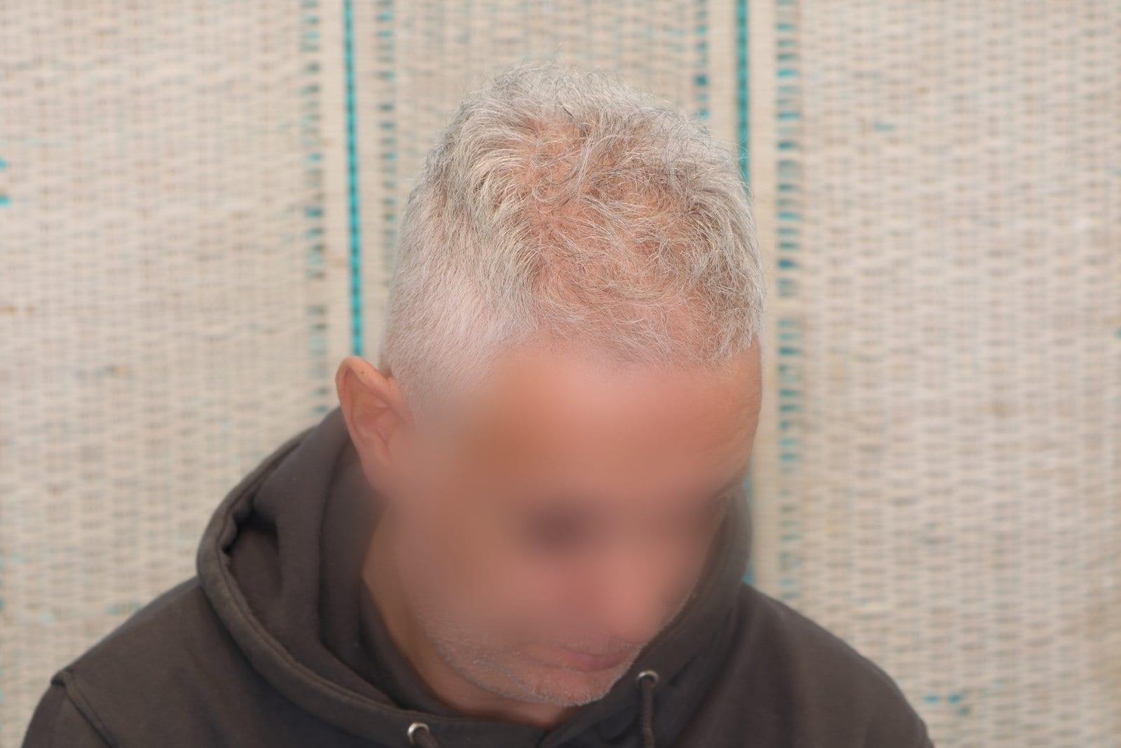 Prima: tricopigmentazione effetto infoltimento a Firenze — Caso Prima / Dopo #22 (foto 2)