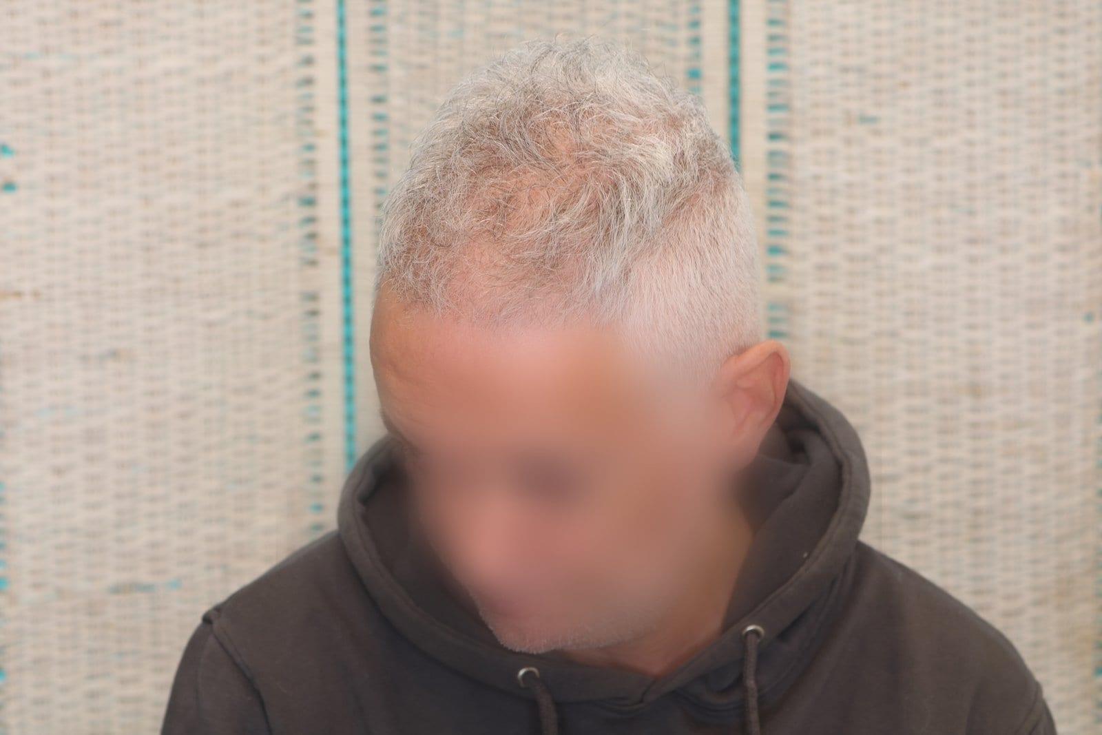 Prima: tricopigmentazione effetto infoltimento a Firenze — Caso Prima / Dopo #22 (foto 3)