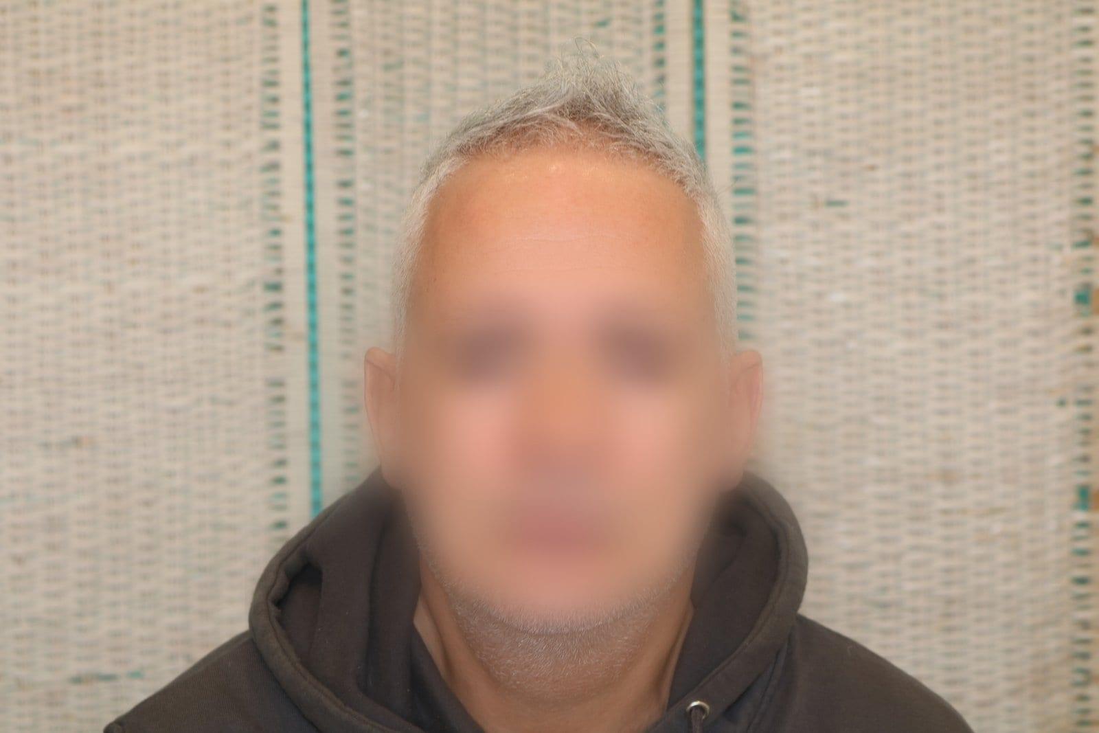 Prima: tricopigmentazione effetto infoltimento a Firenze — Caso Prima / Dopo #22 (foto 4)