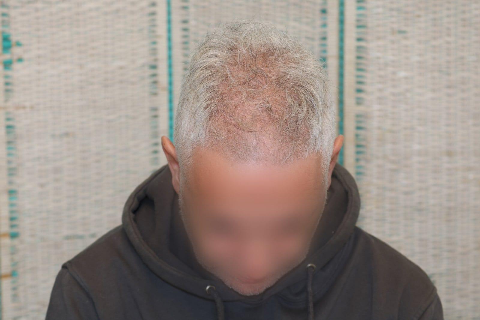 Prima: tricopigmentazione effetto infoltimento a Firenze — Caso Prima / Dopo #22 (foto 5)