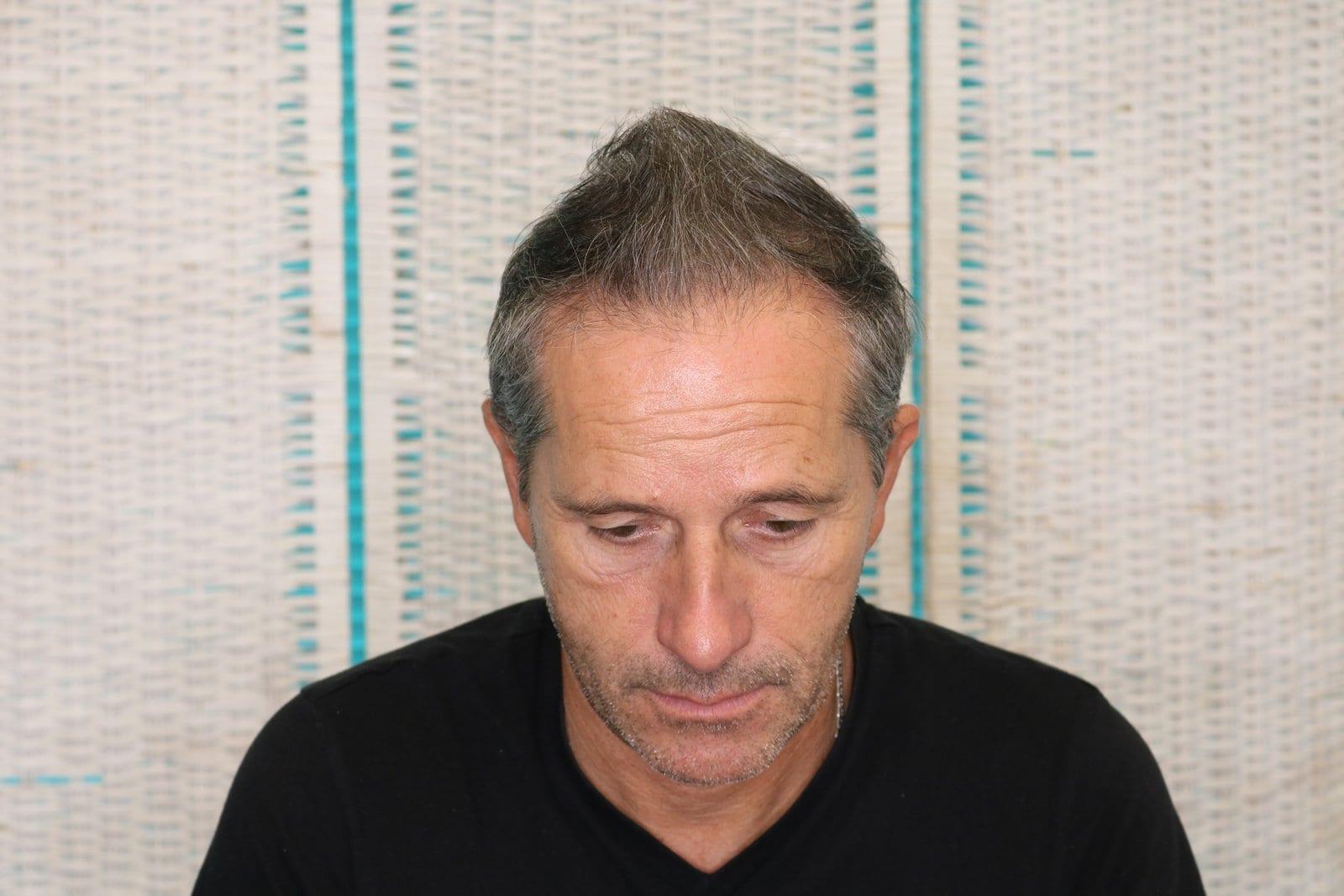 Dopo: tricopigmentazione effetto infoltimento a Firenze — Caso Prima / Dopo #23 (foto 5)