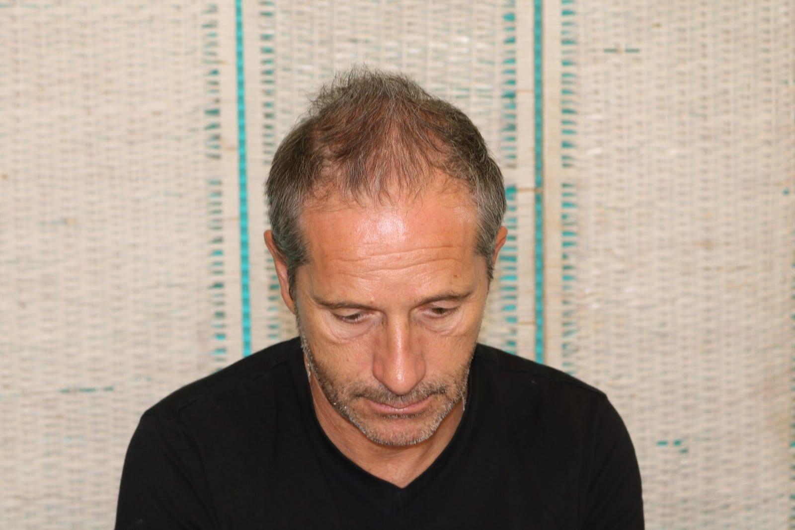 Prima: tricopigmentazione effetto infoltimento a Firenze — Caso Prima / Dopo #23 (foto 1)