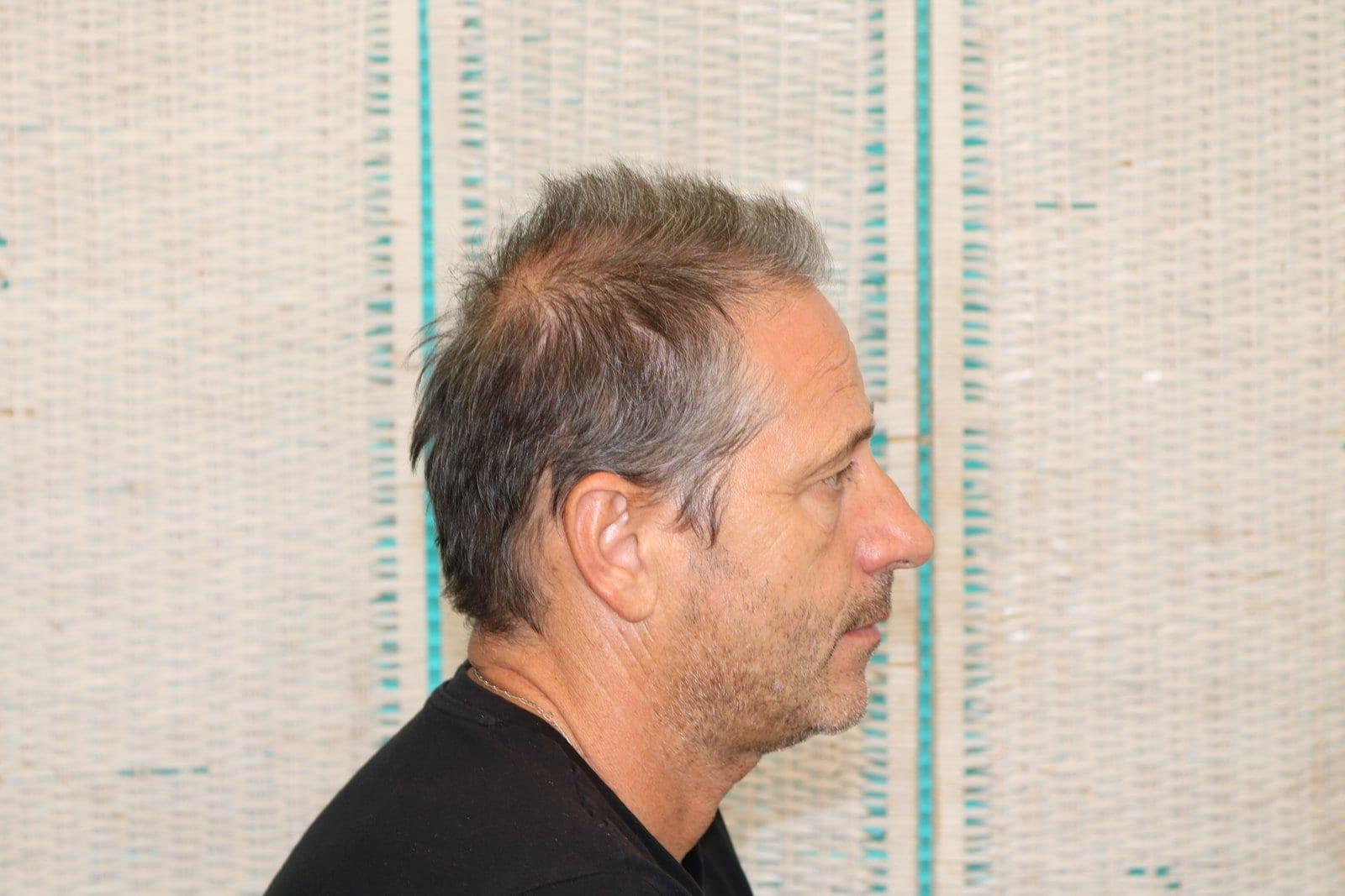 Prima: tricopigmentazione effetto infoltimento a Firenze — Caso Prima / Dopo #23 (foto 2)