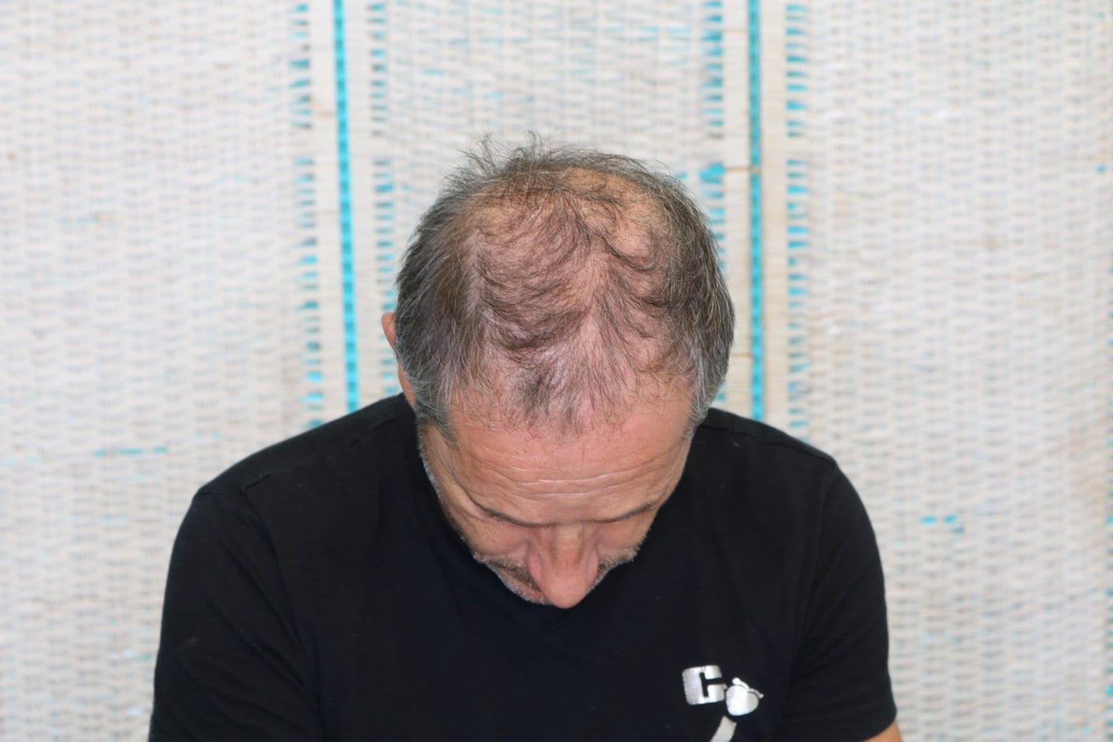 Prima: tricopigmentazione effetto infoltimento a Firenze — Caso Prima / Dopo #23 (foto 3)