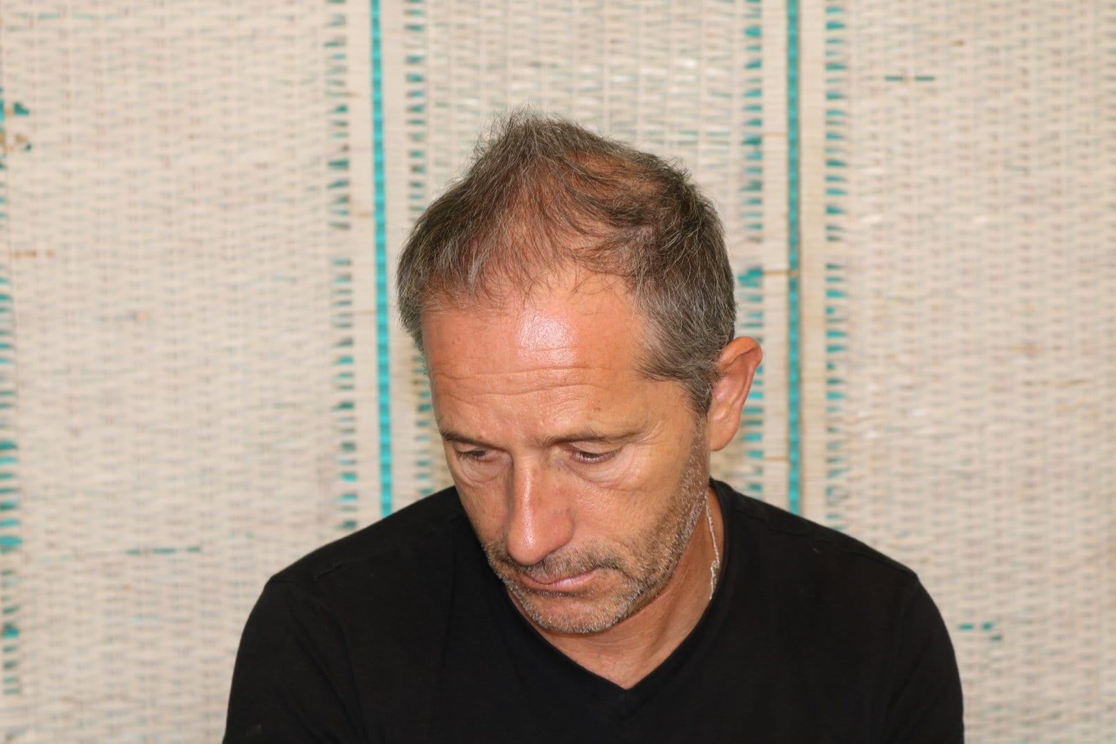 Prima: tricopigmentazione effetto infoltimento a Firenze — Caso Prima / Dopo #23 (foto 4)