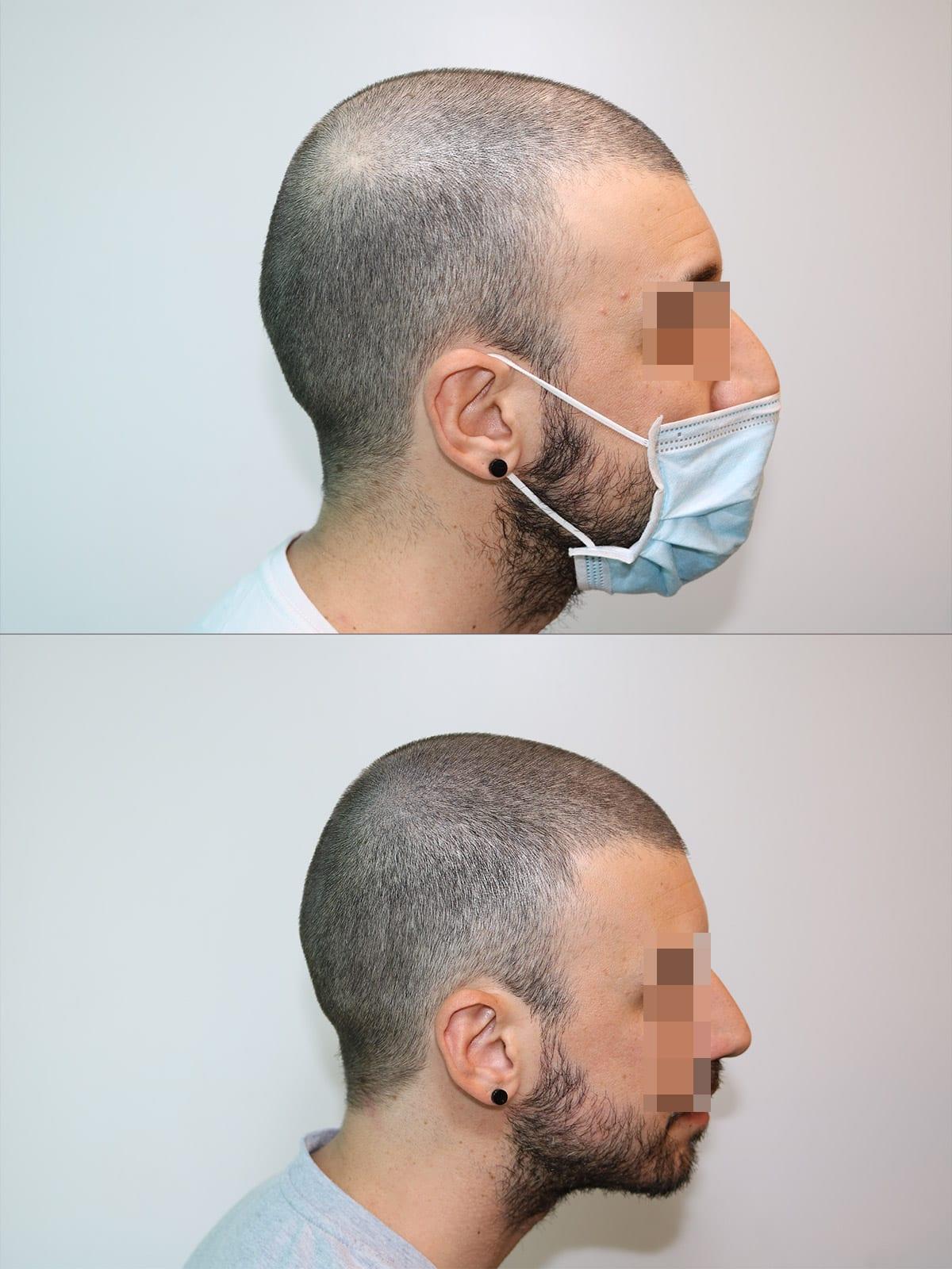 Prima e dopo: tricopigmentazione effetto infoltimento a Firenze — Caso studio #19 (foto 2)