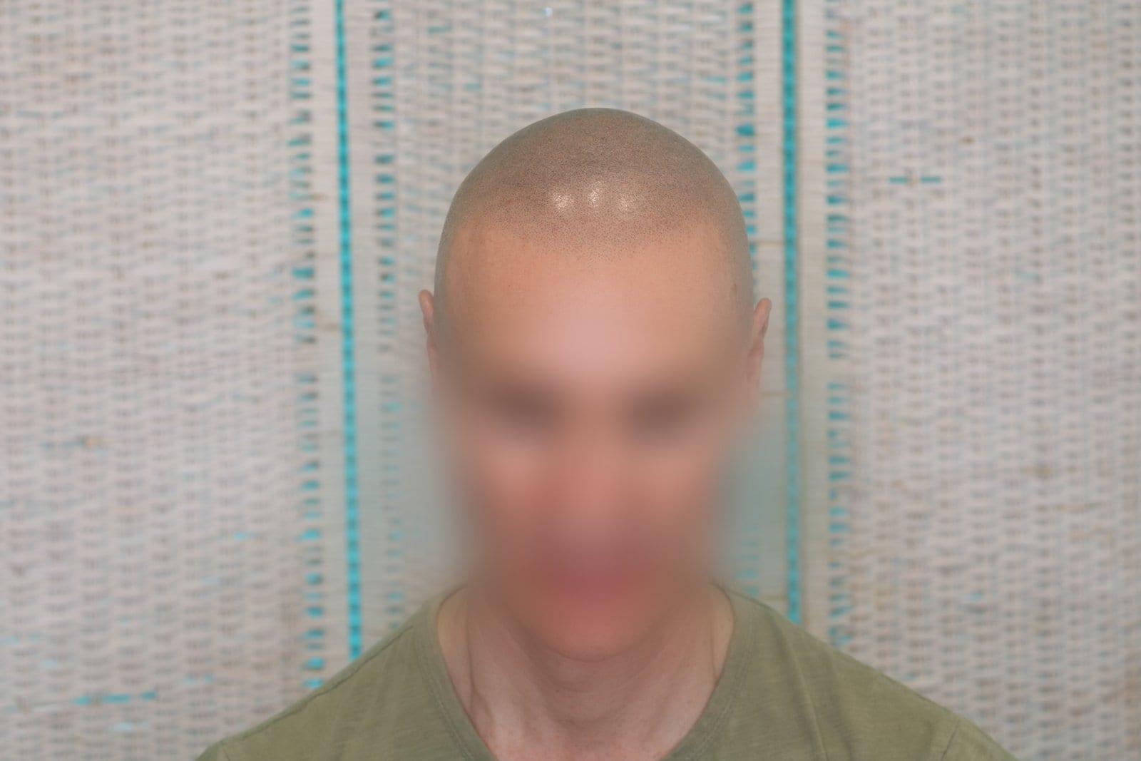 Dopo: tricopigmentazione effetto rasato a Firenze — Caso Prima / Dopo #24 (foto 2)