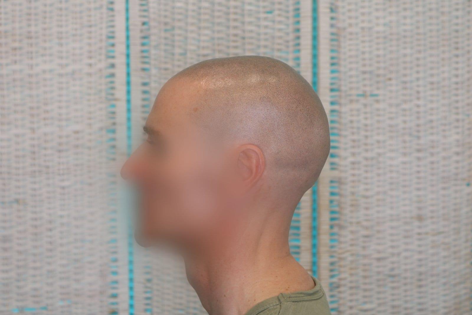 Dopo: tricopigmentazione effetto rasato a Firenze — Caso Prima / Dopo #24 (foto 3)