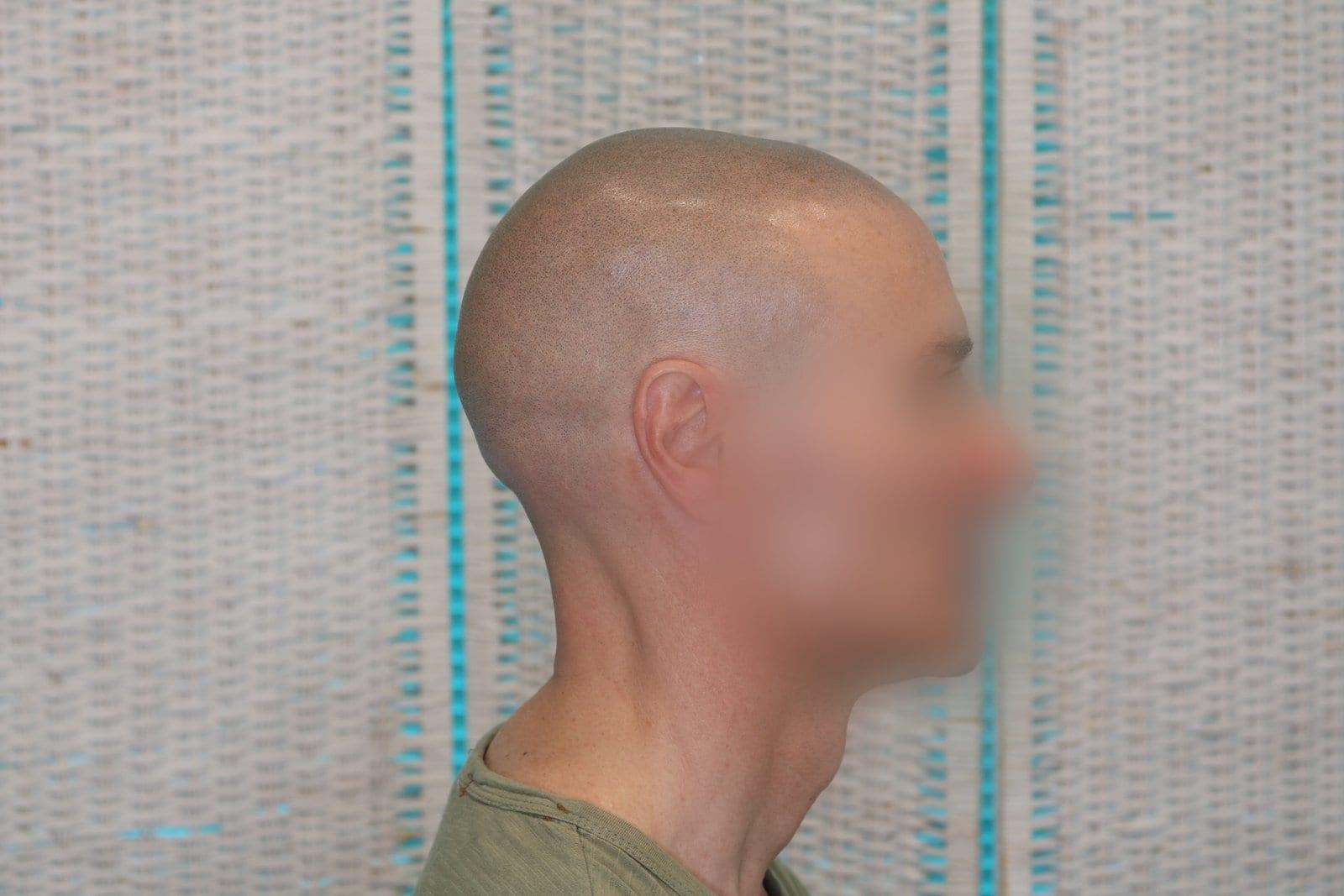 Dopo: tricopigmentazione effetto rasato a Firenze — Caso Prima / Dopo #24 (foto 4)