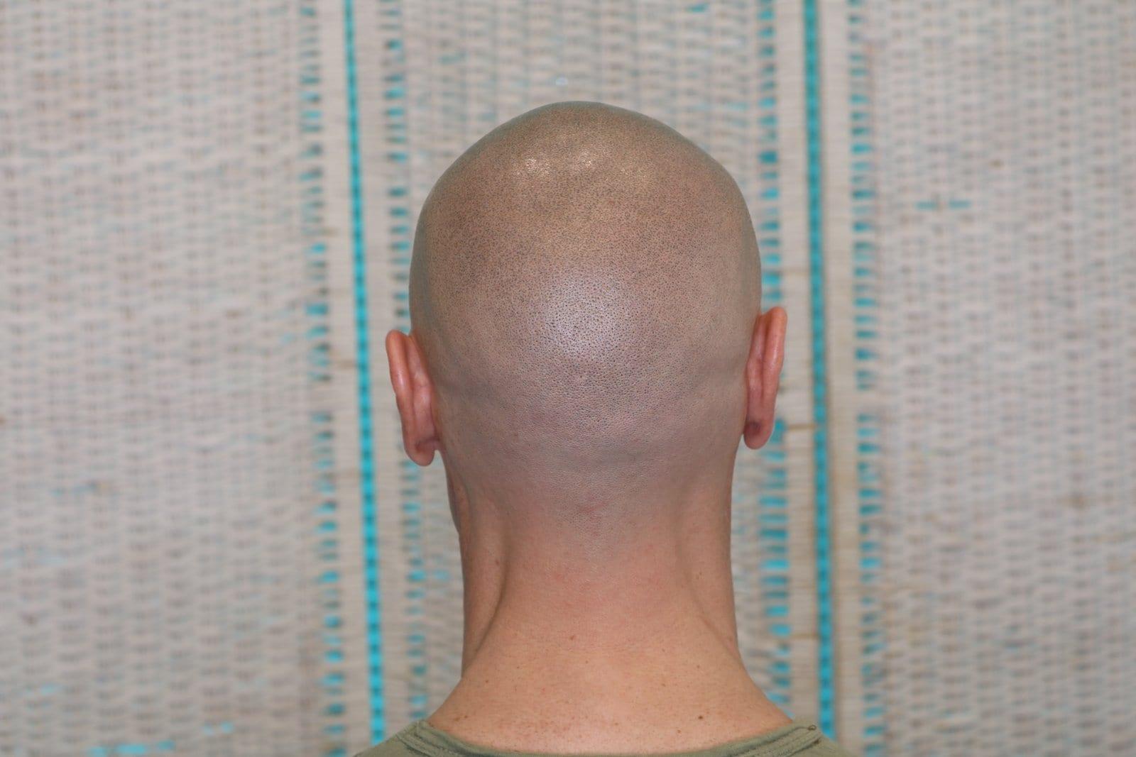 Dopo: tricopigmentazione effetto rasato a Firenze — Caso Prima / Dopo #24 (foto 6)