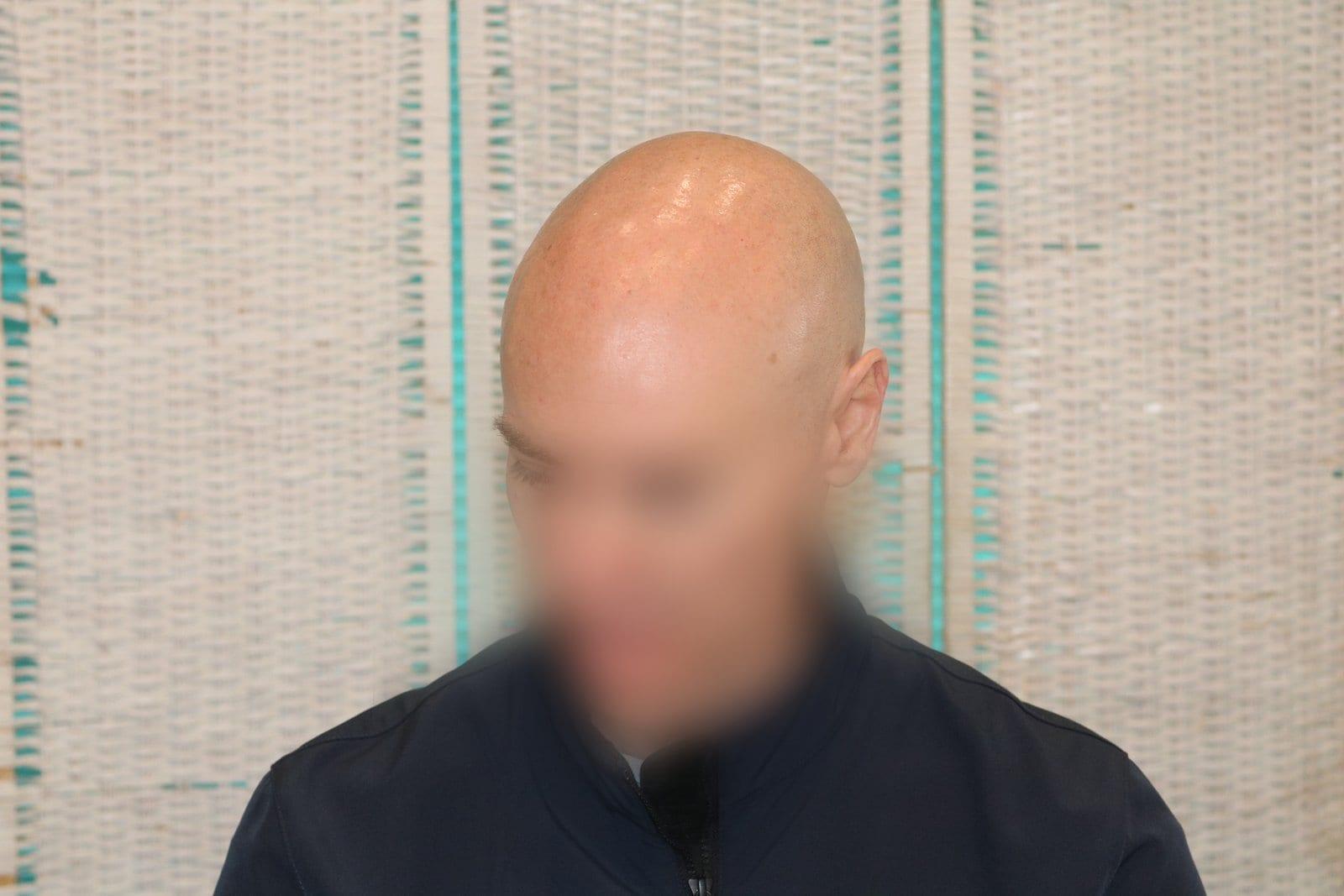 Prima: tricopigmentazione effetto rasato a Firenze — Caso Prima / Dopo #24 (foto 1)