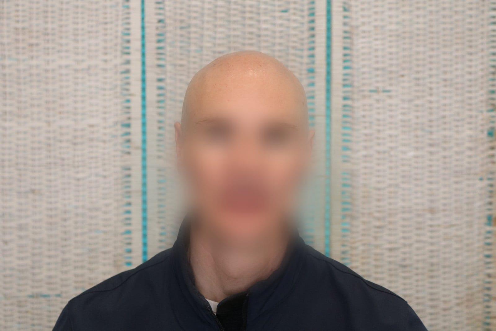 Prima: tricopigmentazione effetto rasato a Firenze — Caso Prima / Dopo #24 (foto 4)