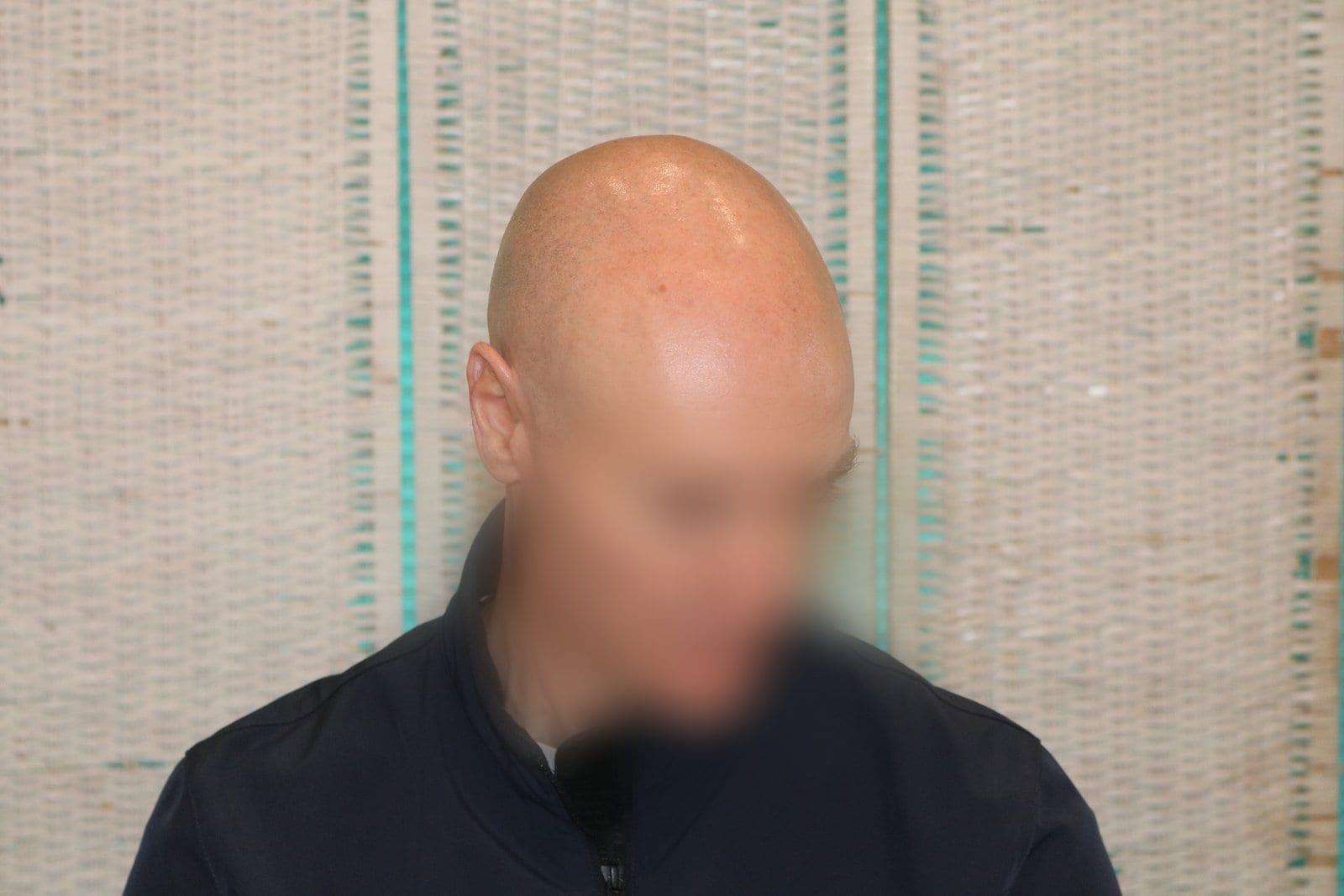 Prima: tricopigmentazione effetto rasato a Firenze — Caso Prima / Dopo #24 (foto 5)