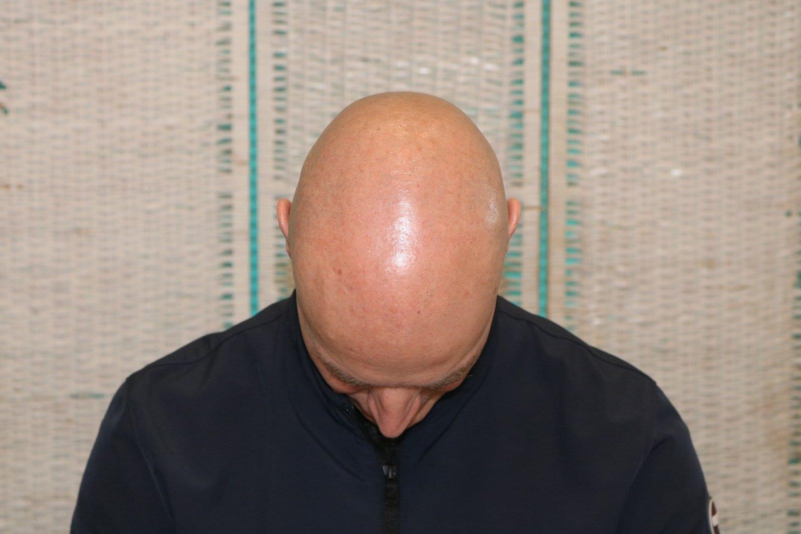Prima: tricopigmentazione effetto rasato a Firenze — Caso Prima / Dopo #24 (foto 6)