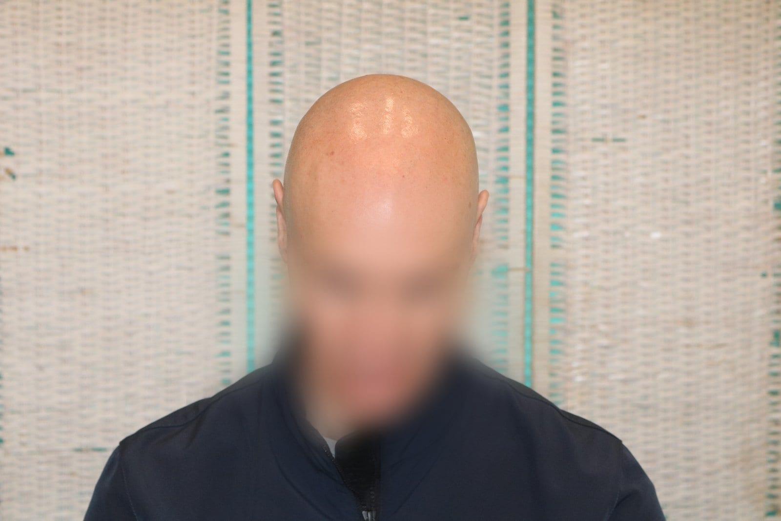 Prima: tricopigmentazione effetto rasato a Firenze — Caso Prima / Dopo #24 (foto 8)