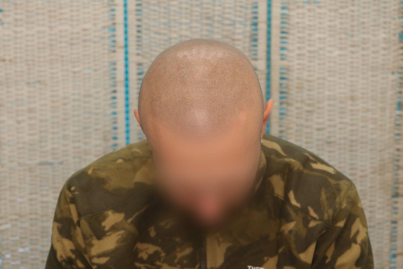 Dopo: tricopigmentazione effetto rasato a Firenze — Caso Prima / Dopo #25 (foto 2)