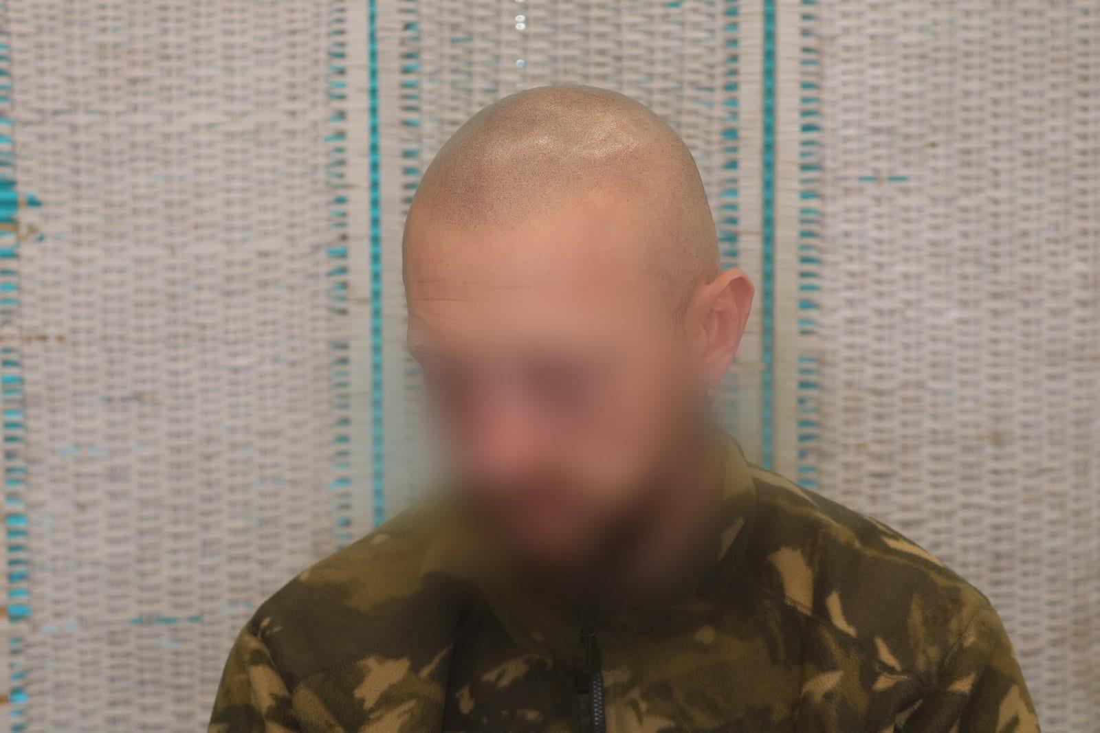 Dopo: tricopigmentazione effetto rasato a Firenze — Caso Prima / Dopo #25 (foto 3)