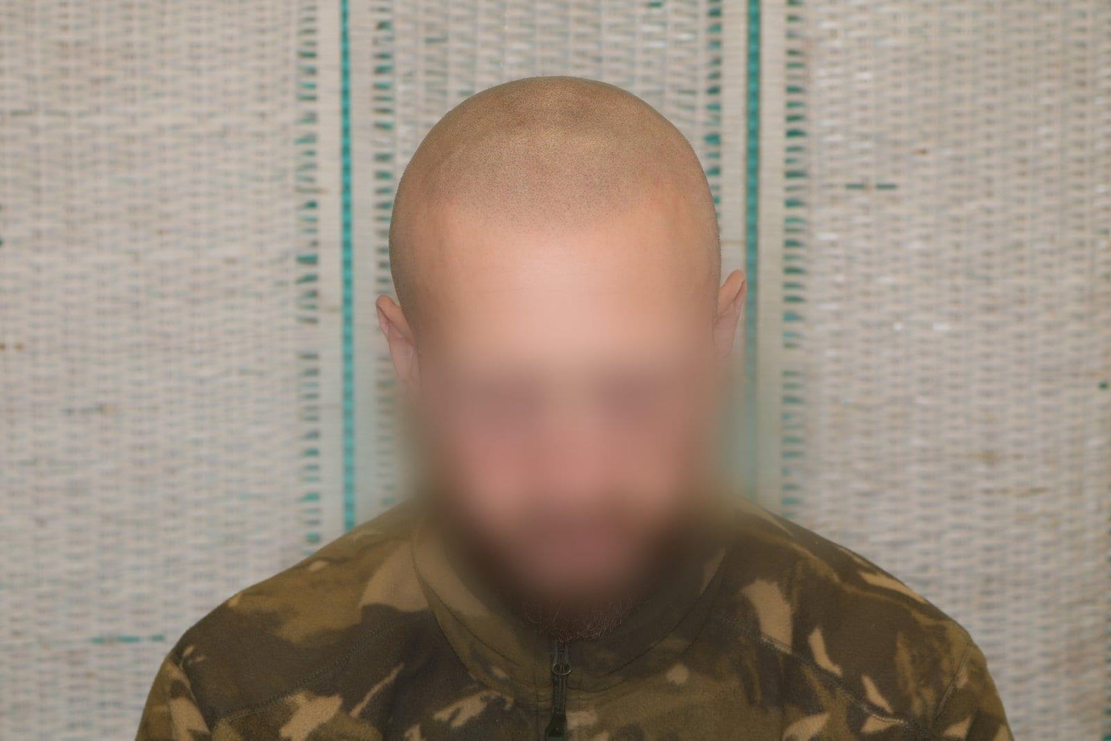 Dopo: tricopigmentazione effetto rasato a Firenze — Caso Prima / Dopo #25 (foto 4)