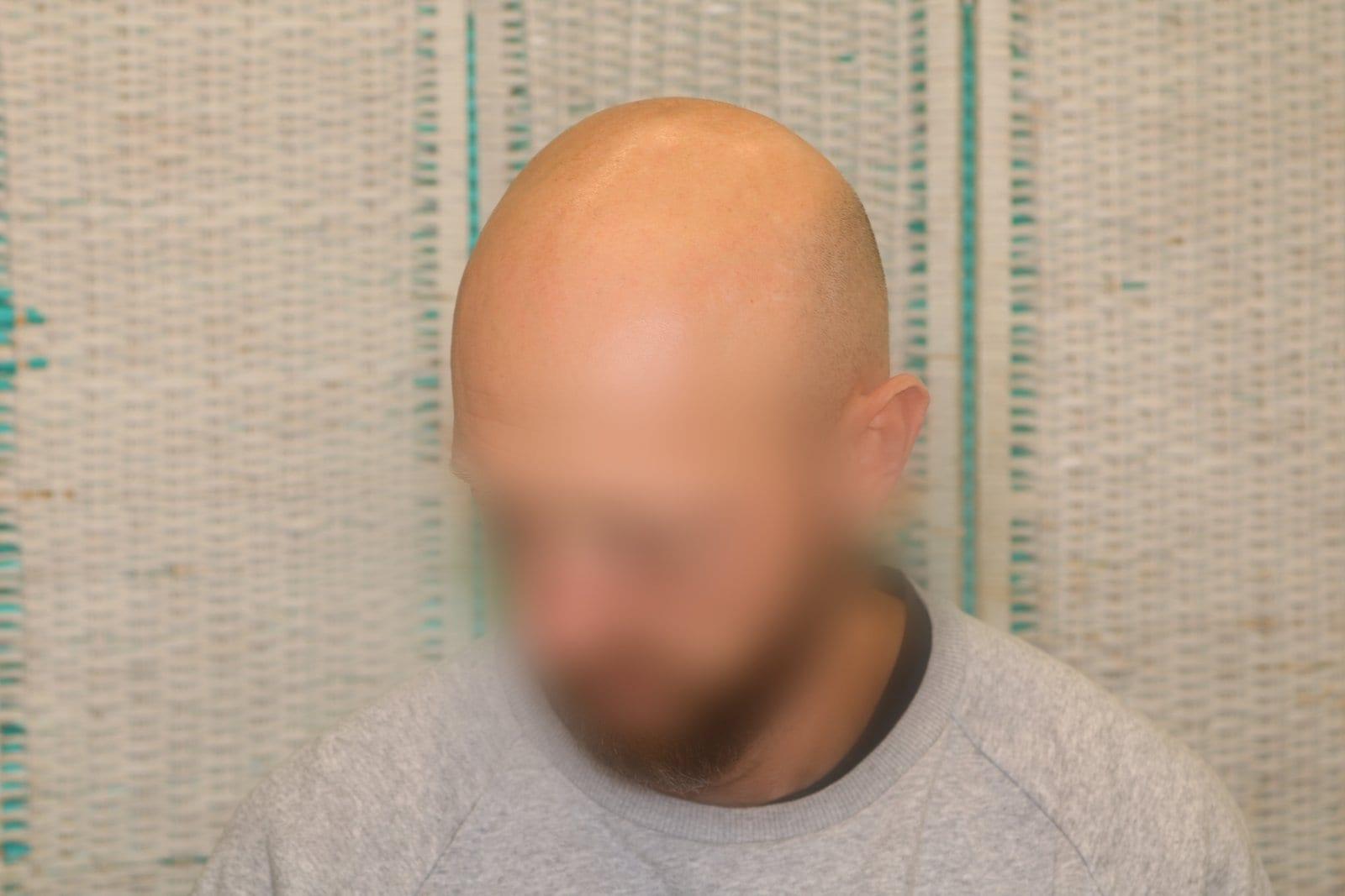 Prima: tricopigmentazione effetto rasato a Firenze — Caso Prima / Dopo #25 (foto 2)