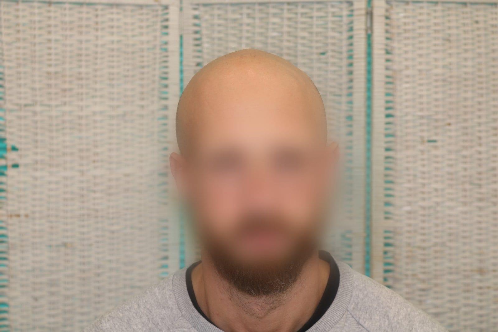 Prima: tricopigmentazione effetto rasato a Firenze — Caso Prima / Dopo #25 (foto 3)