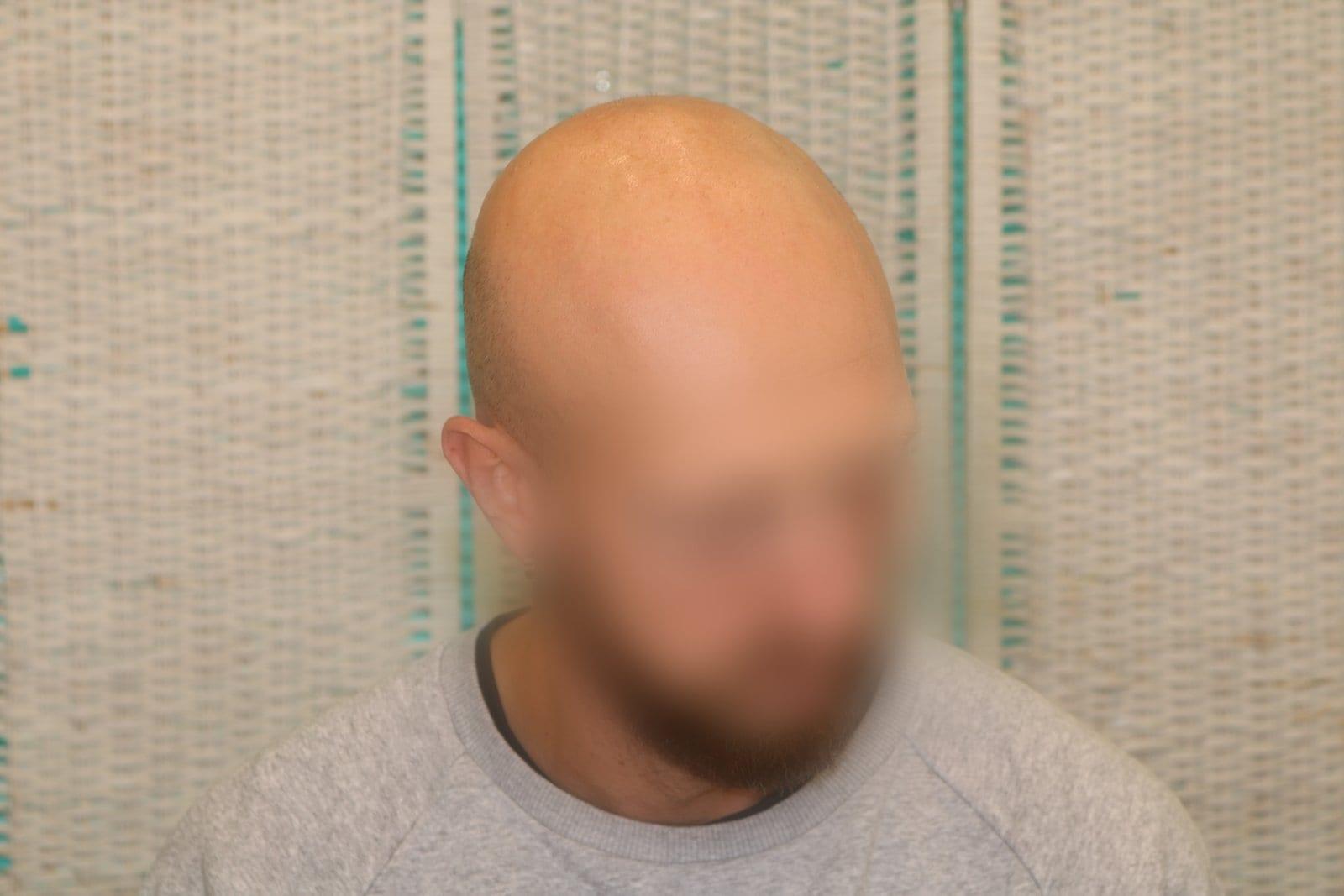 Prima: tricopigmentazione effetto rasato a Firenze — Caso Prima / Dopo #25 (foto 4)