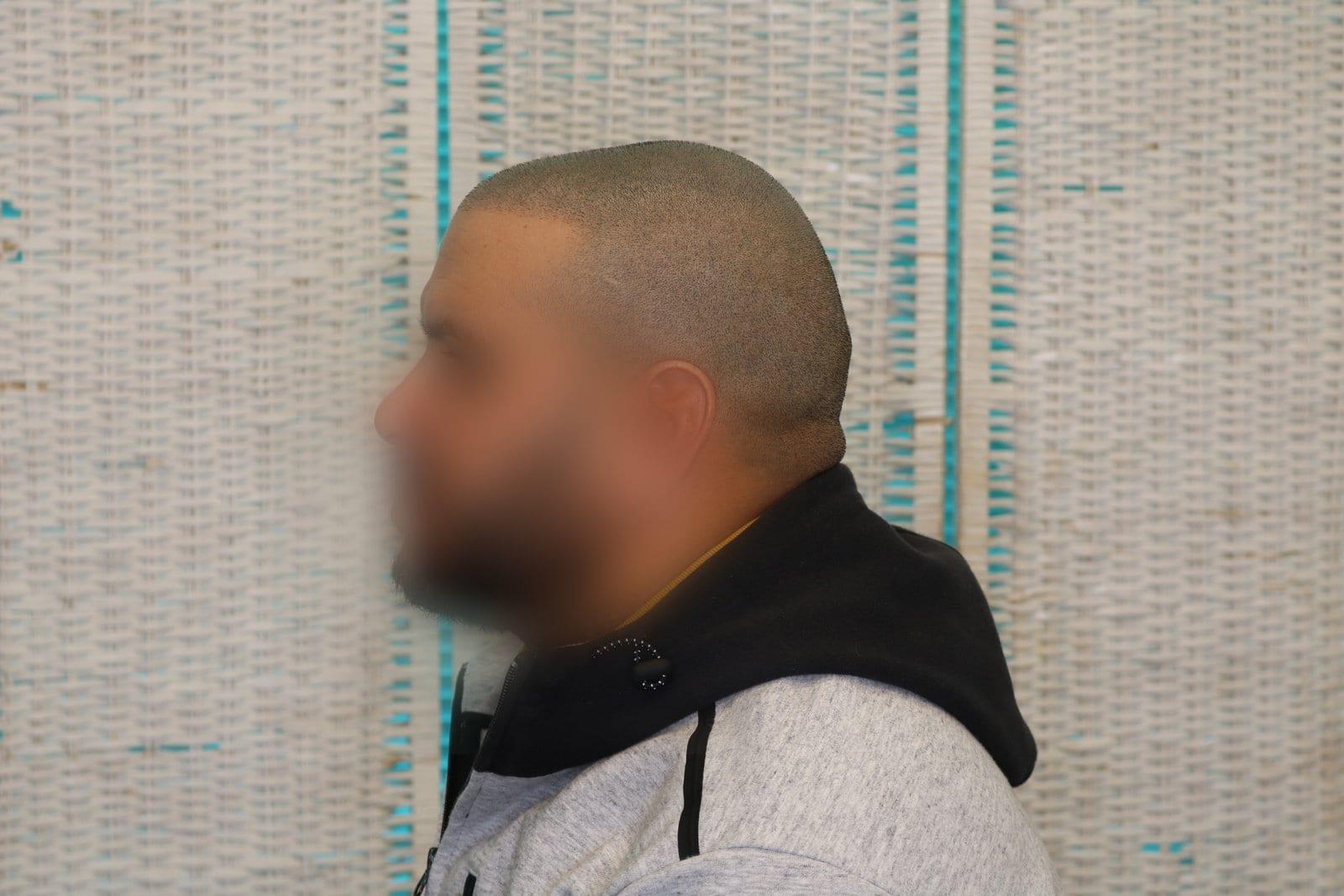 Tricopigmentazione, dopo, caso #26, Firenze