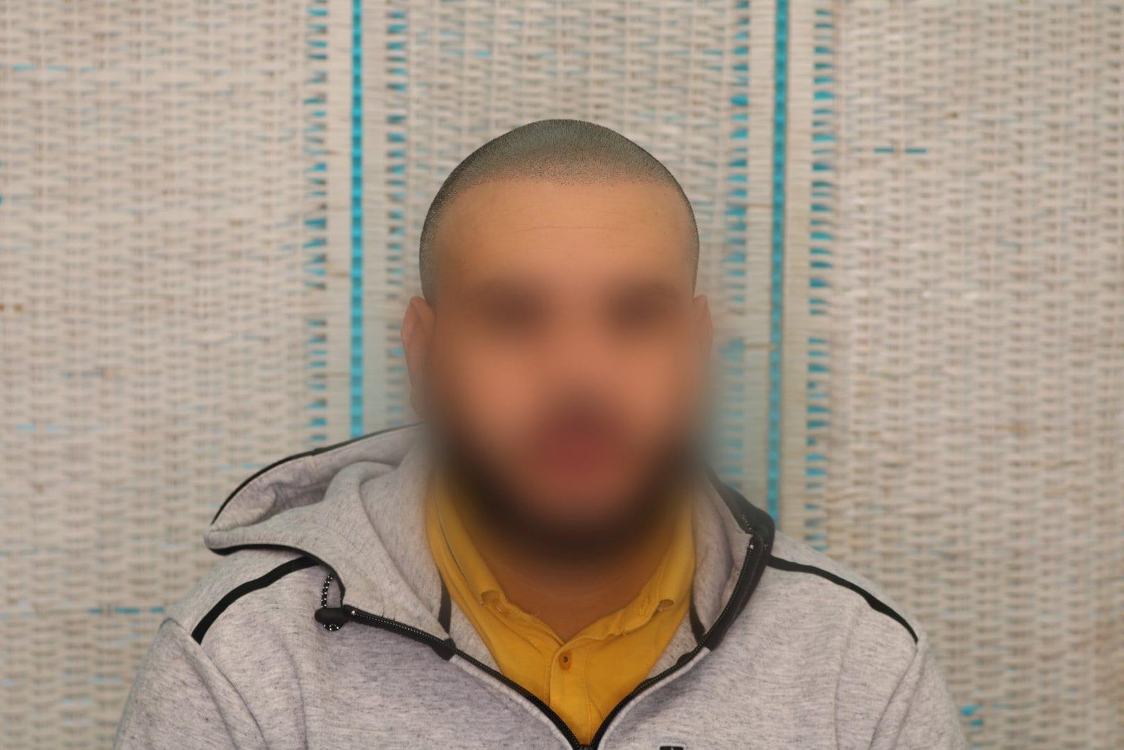 Dopo: tricopigmentazione effetto rasato a Firenze — Caso Prima / Dopo #26 (foto 4)